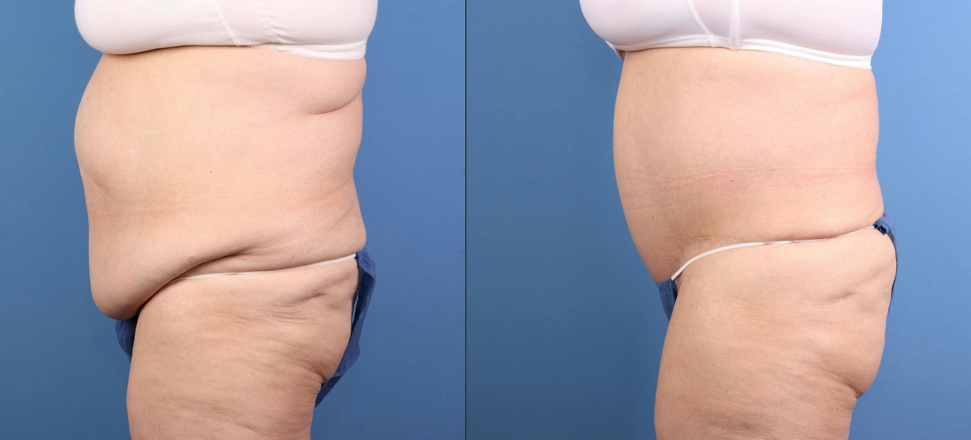 Tummy Tuck Before & After Gallery - Patient 632059 - Image 2