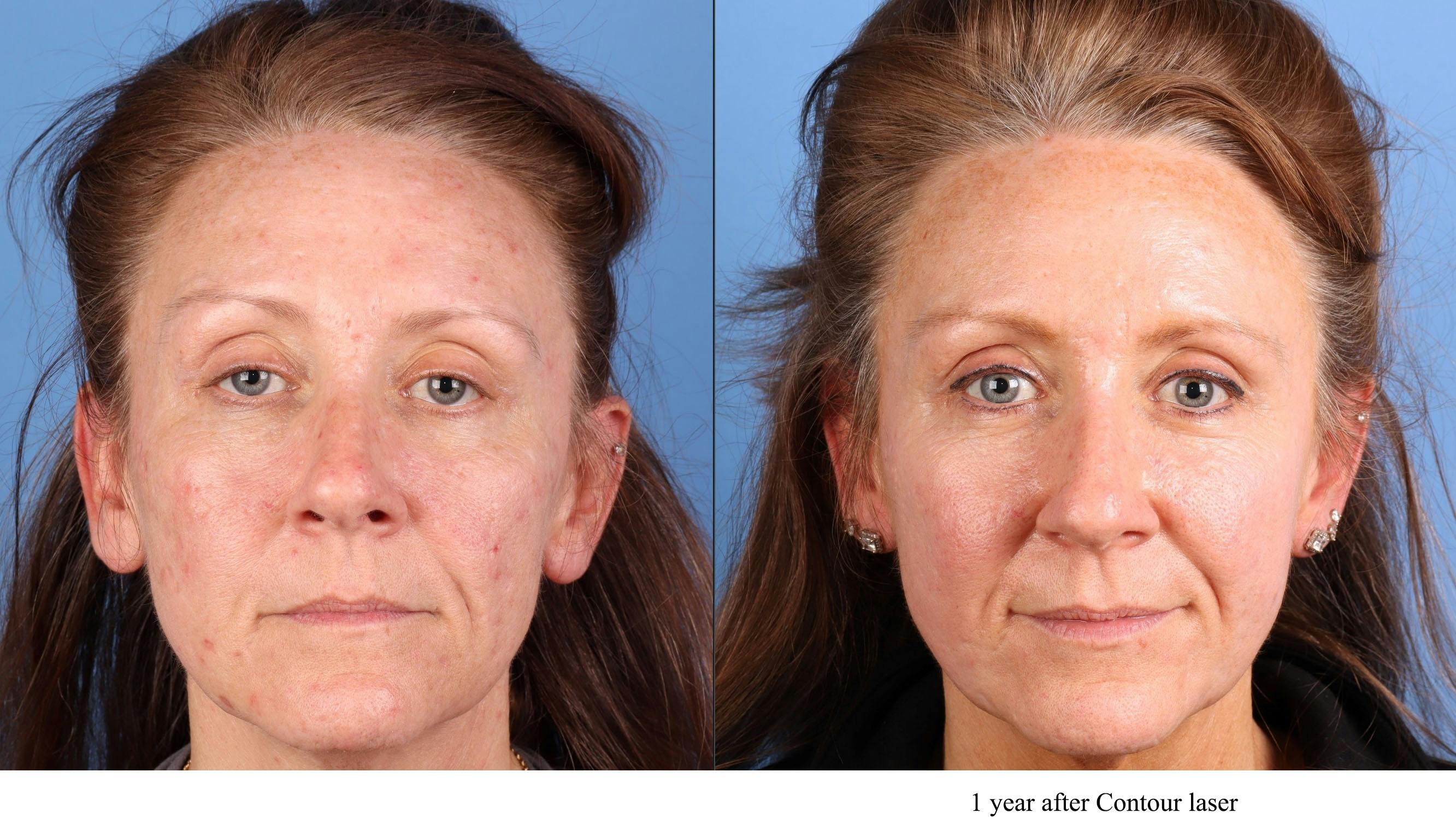 Acne Scar Treatment Before & After Gallery - Patient 465721 - Image 1