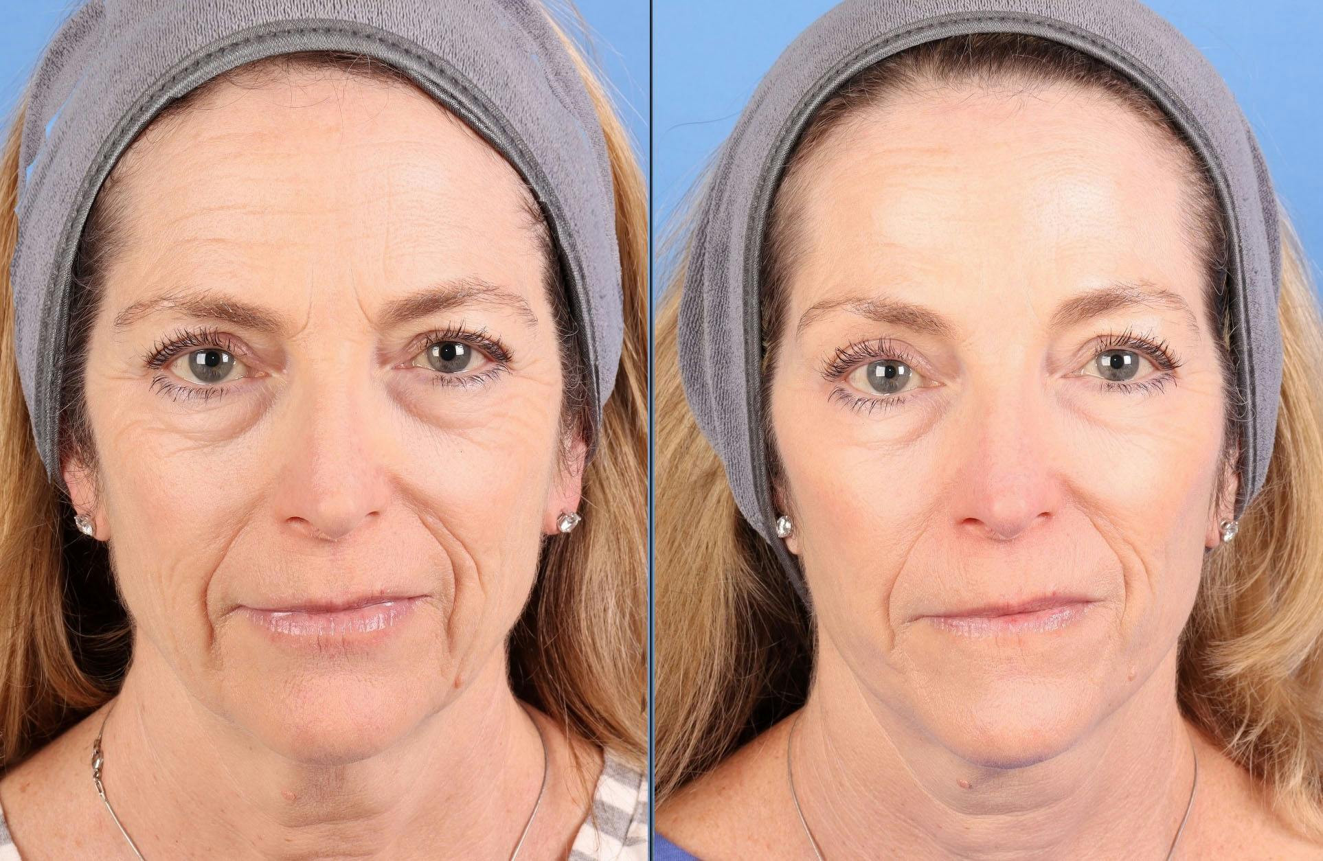 Face Lift Before & After Gallery - Patient 645152 - Image 2