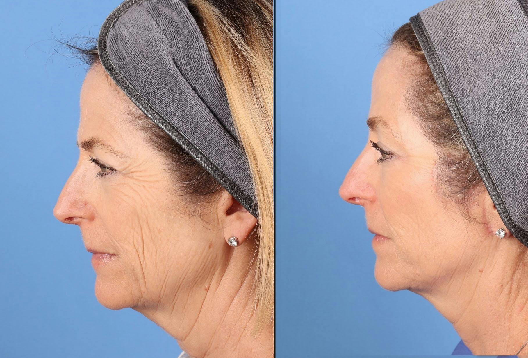 Face Lift Before & After Gallery - Patient 645152 - Image 4