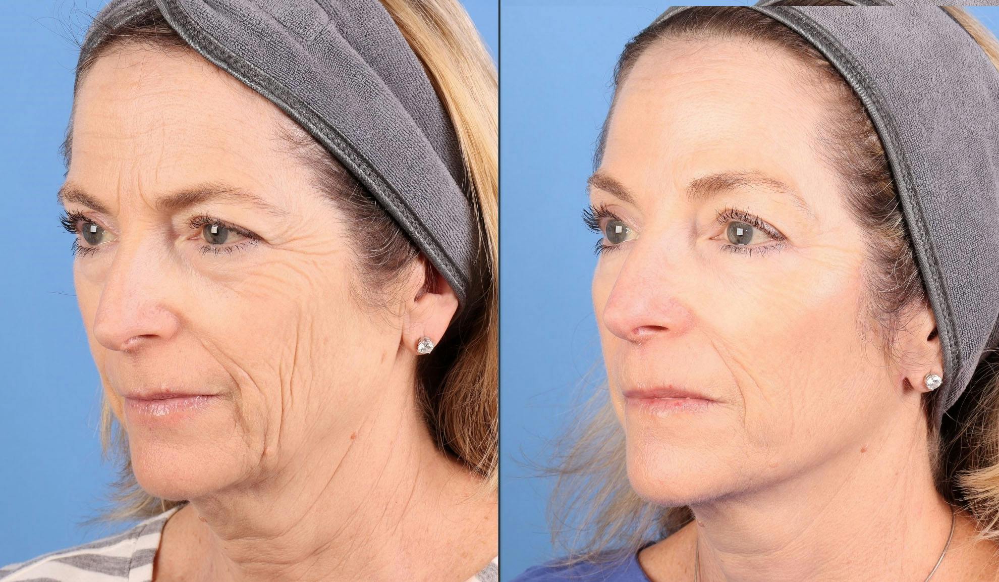 Face Lift Before & After Gallery - Patient 645152 - Image 1