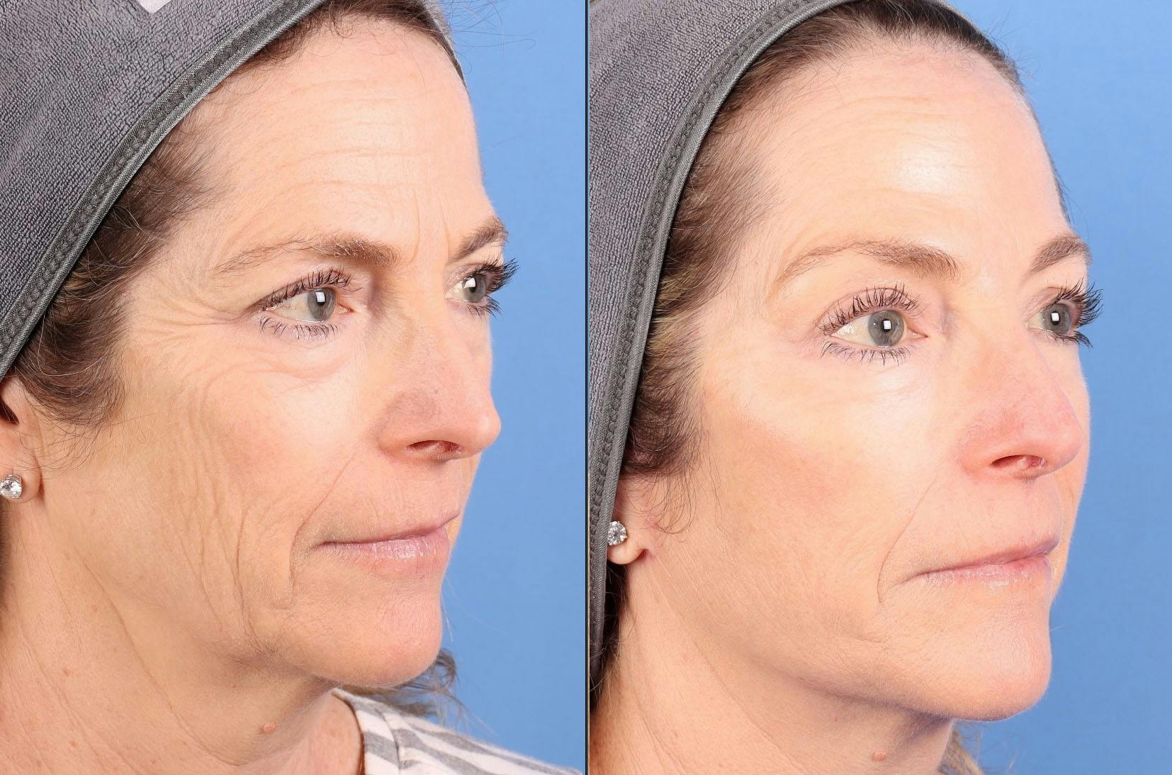 Face Lift Before & After Gallery - Patient 645152 - Image 3