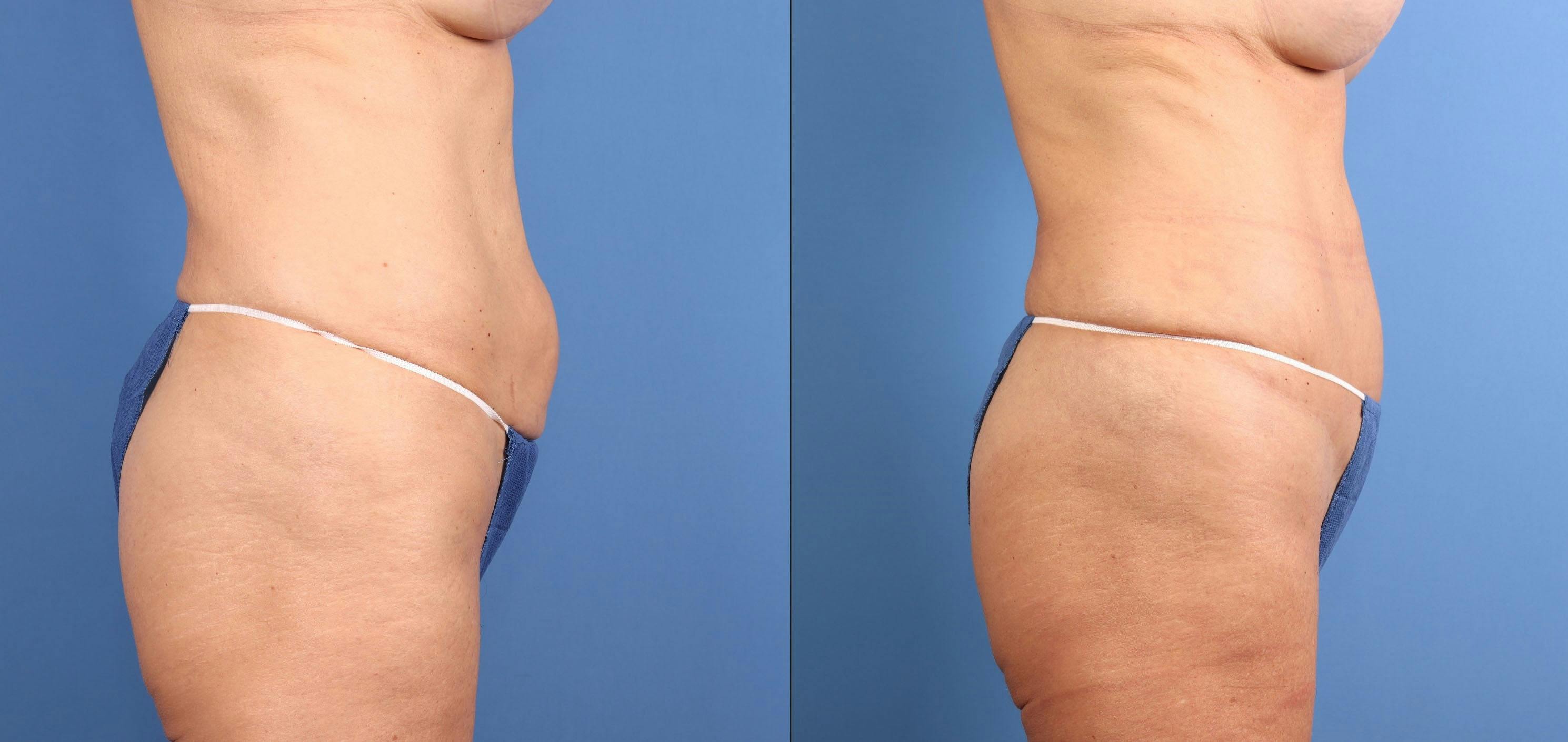 Tummy Tuck Before & After Gallery - Patient 392451 - Image 3