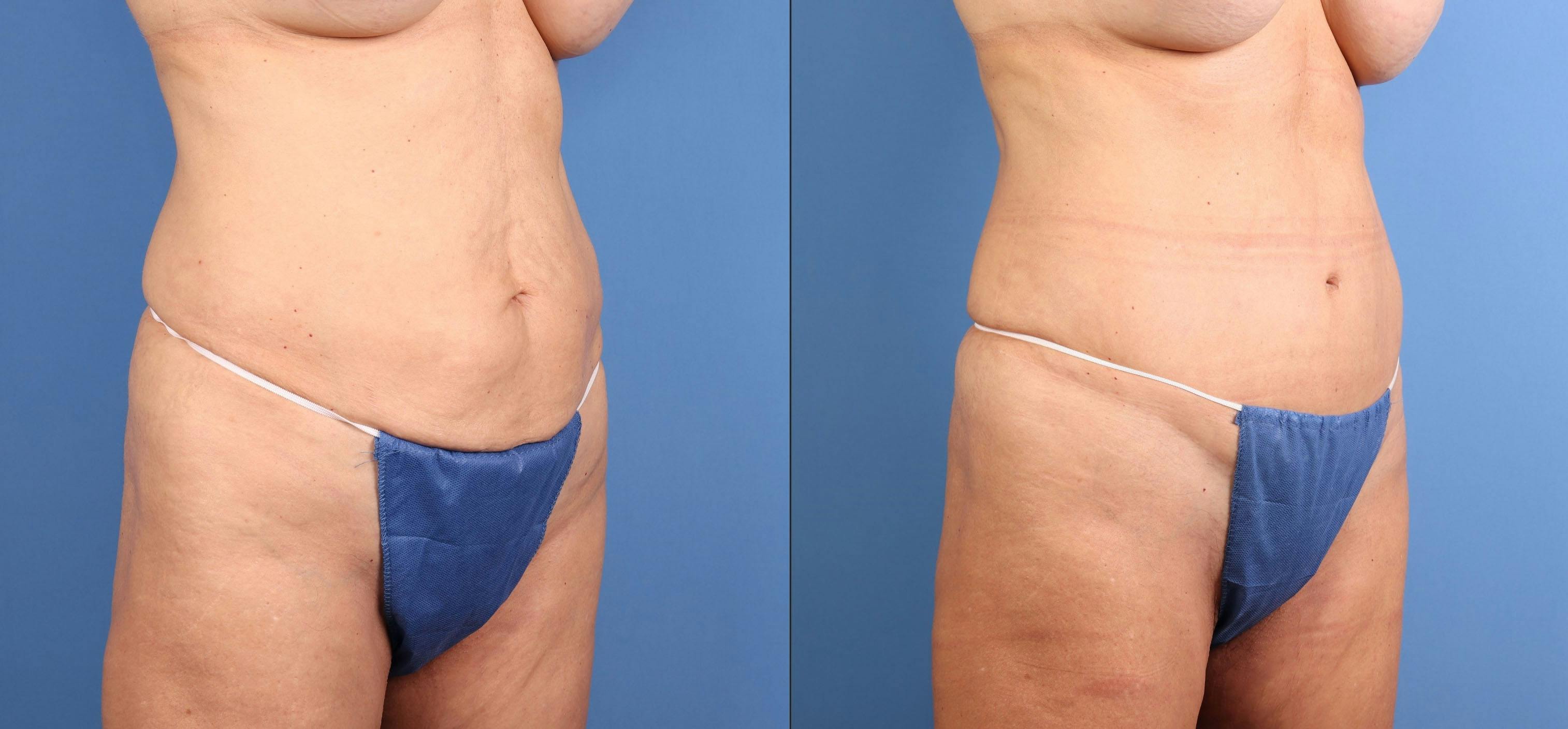 Tummy Tuck Before & After Gallery - Patient 392451 - Image 2