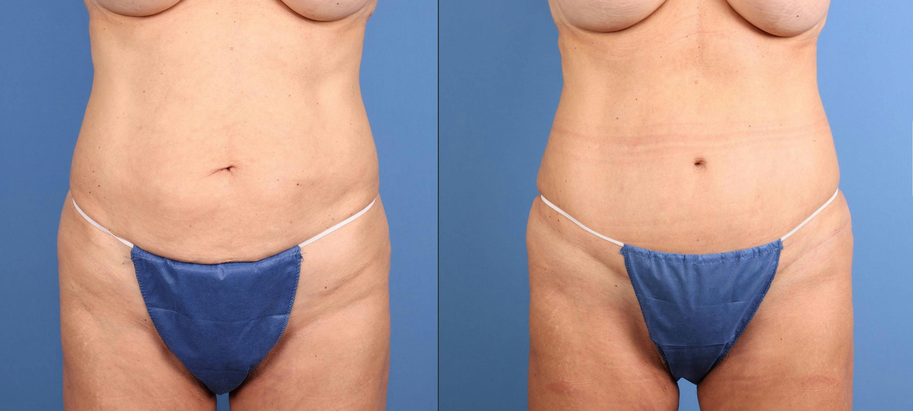 Tummy Tuck Before & After Gallery - Patient 392451 - Image 1