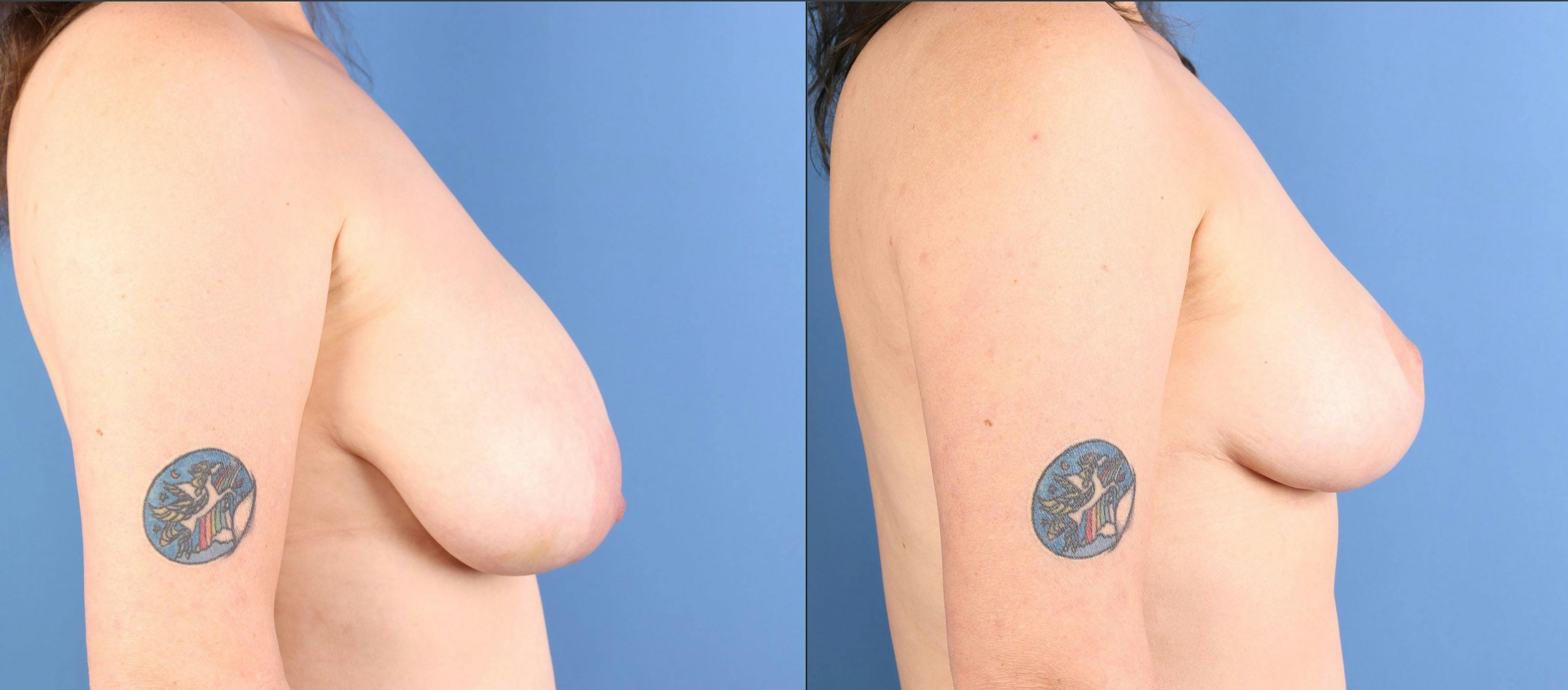 Breast Reduction Before & After Gallery - Patient 280809 - Image 3