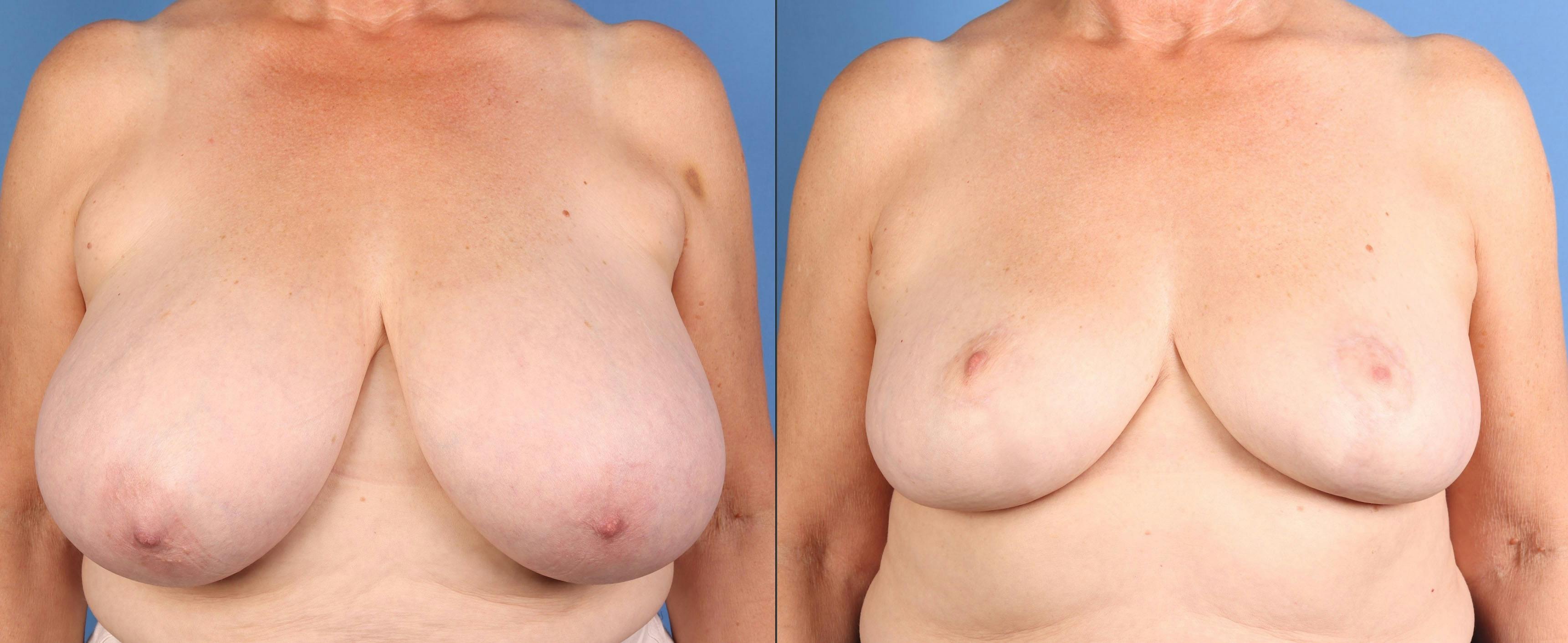 Breast Reduction Before & After Gallery - Patient 299510 - Image 1