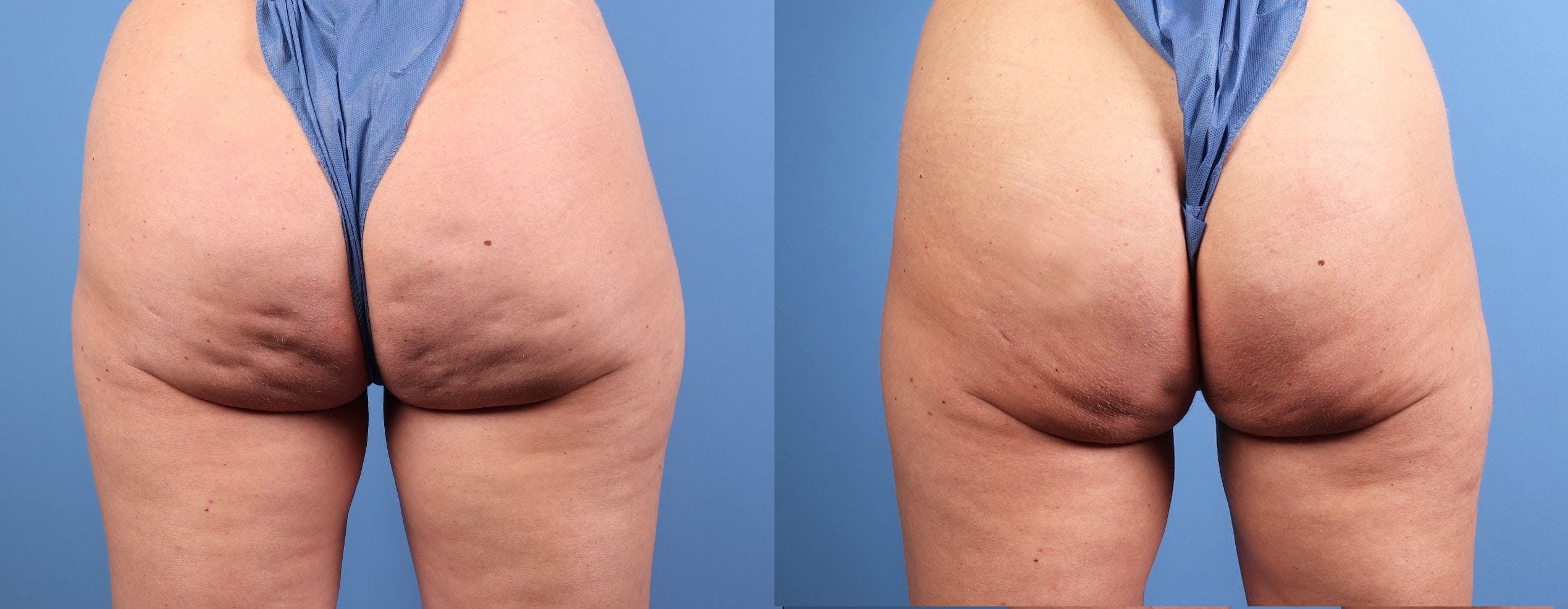 Aveli Before & After Gallery - Patient 235398 - Image 1