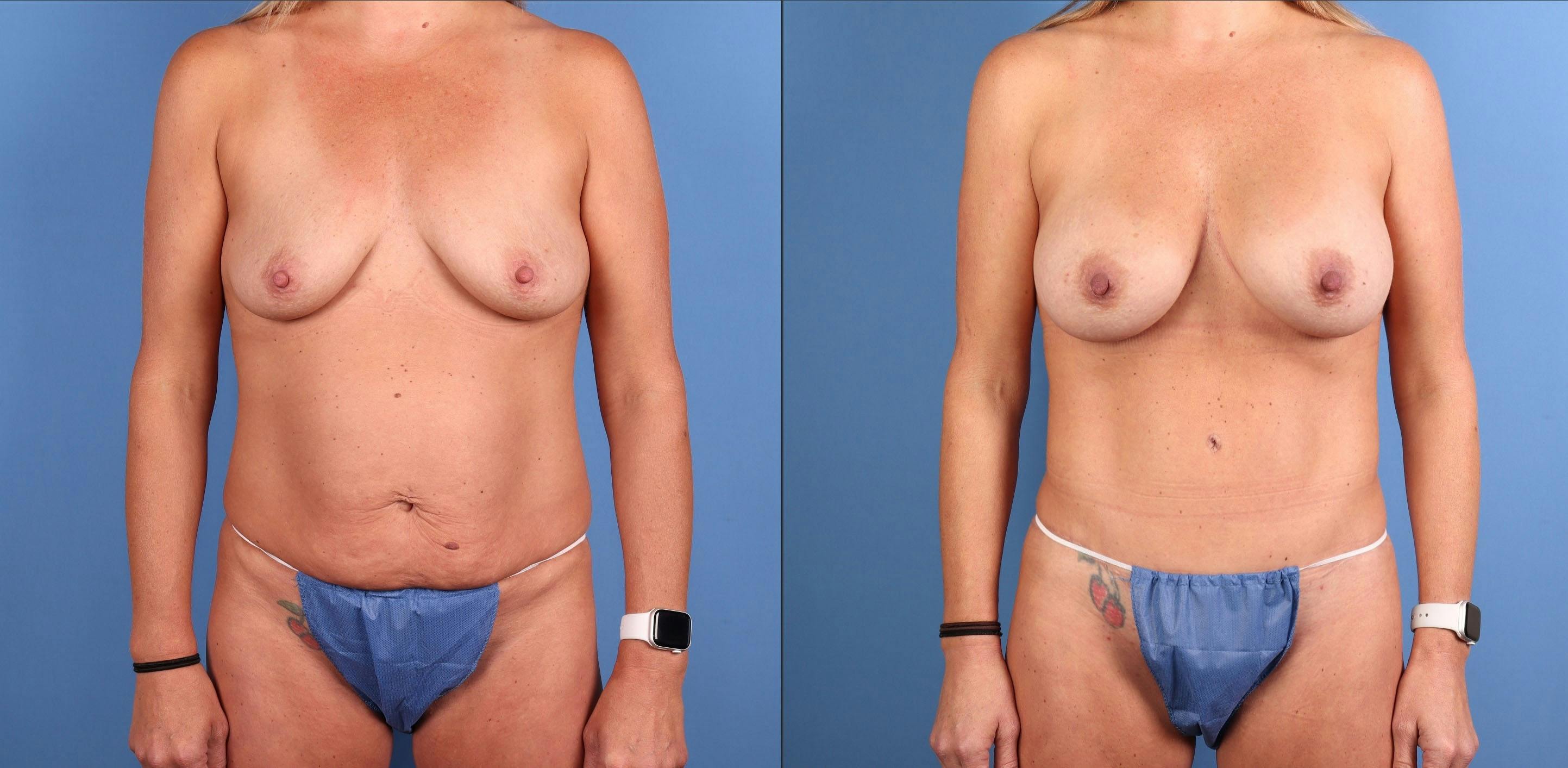 Mommy Makeover Before & After Gallery - Patient 127893 - Image 1