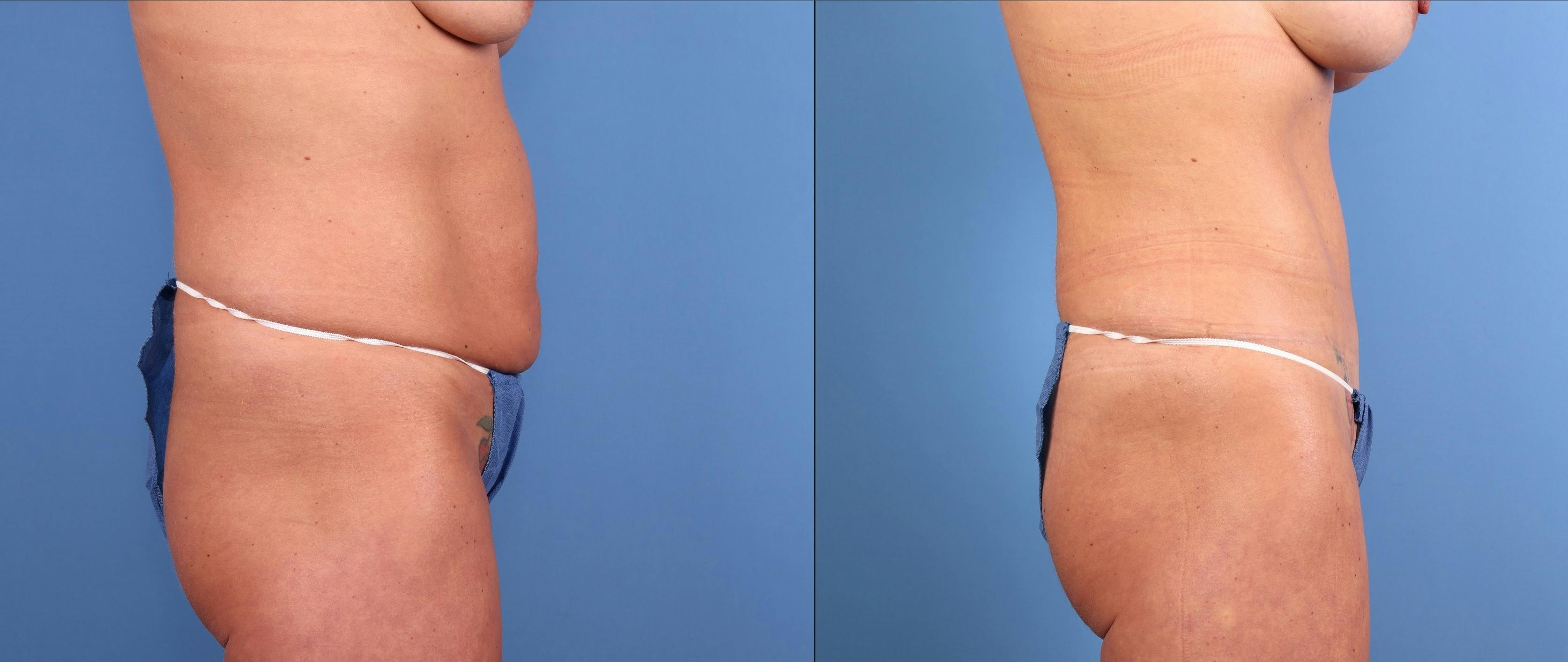 Mommy Makeover Before & After Gallery - Patient 127893 - Image 3