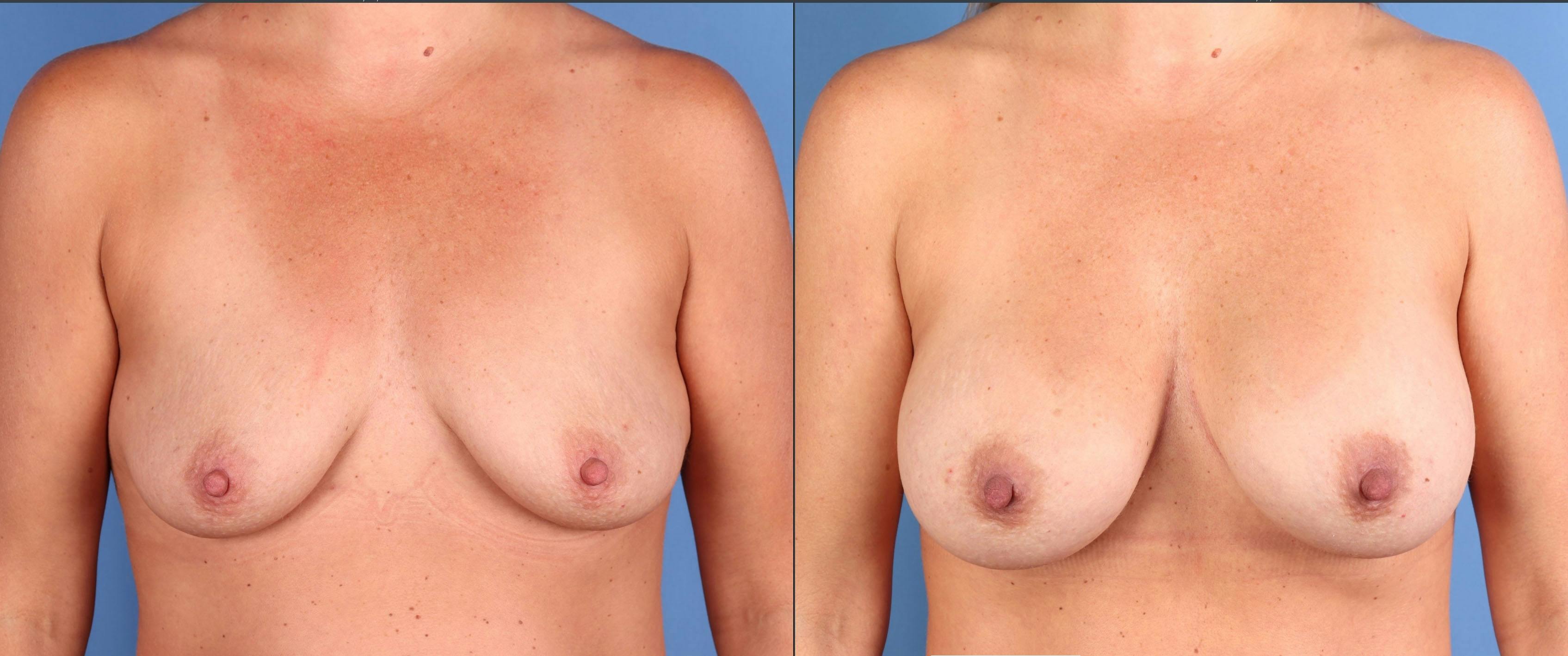 Breast Augmentation Before & After Gallery - Patient 836596 - Image 1