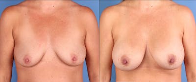 Breast Augmentation Before & After Gallery - Patient 836596 - Image 1