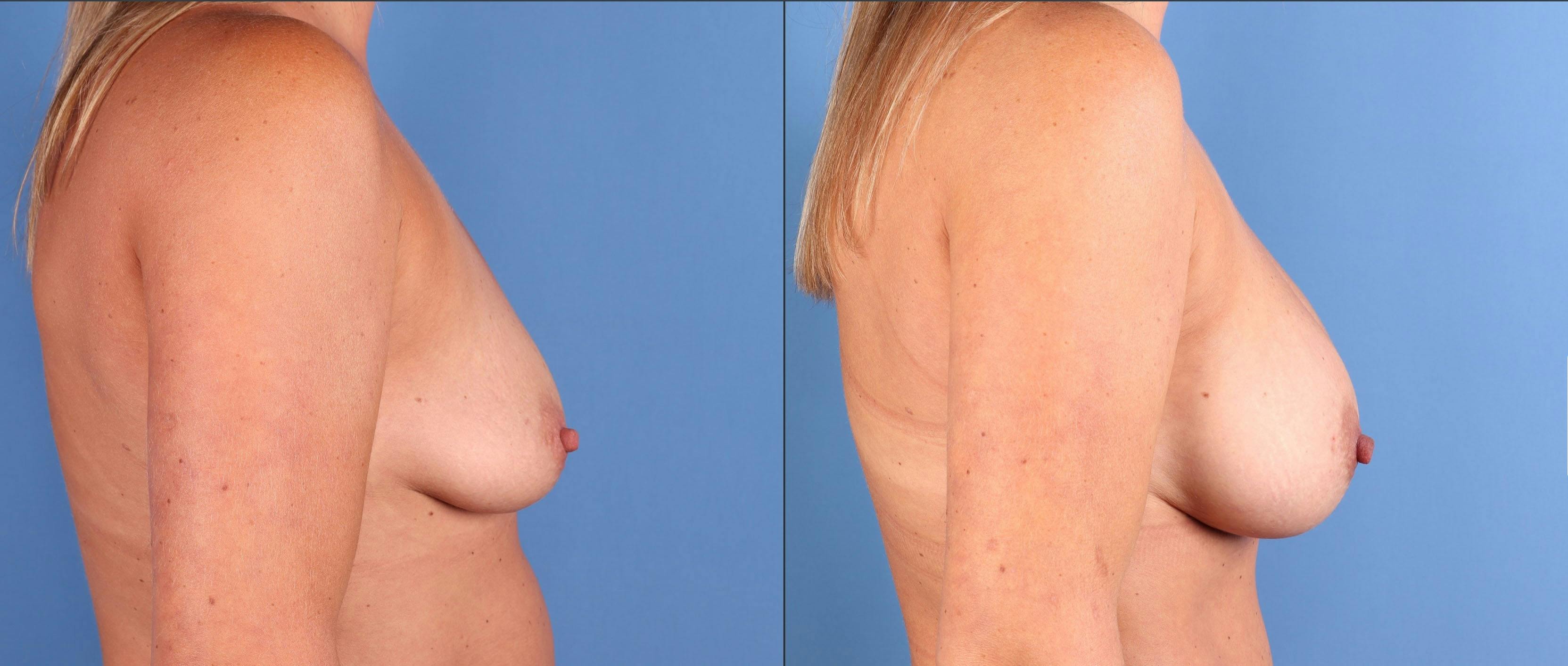 Breast Augmentation Before & After Gallery - Patient 836596 - Image 3