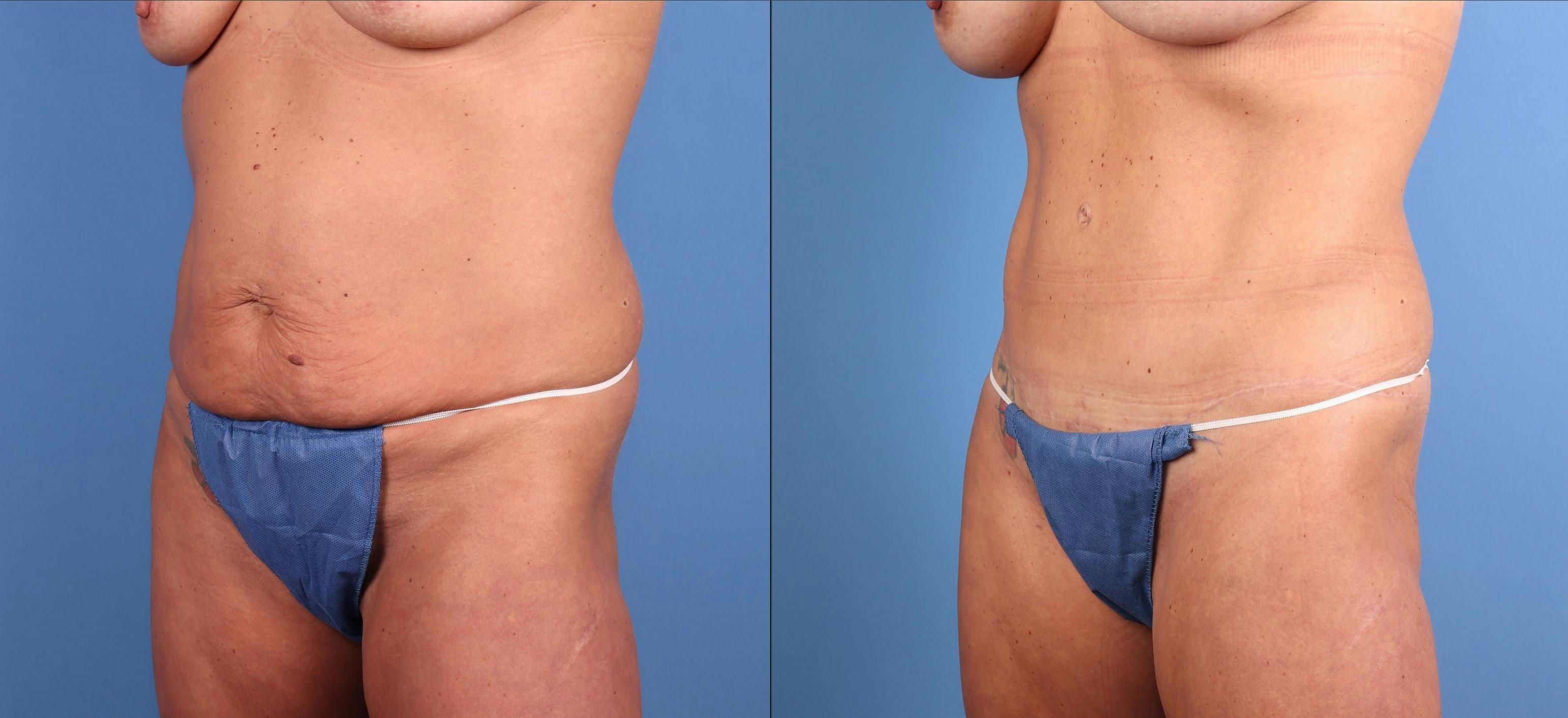 Mommy Makeover Before & After Gallery - Patient 127893 - Image 4