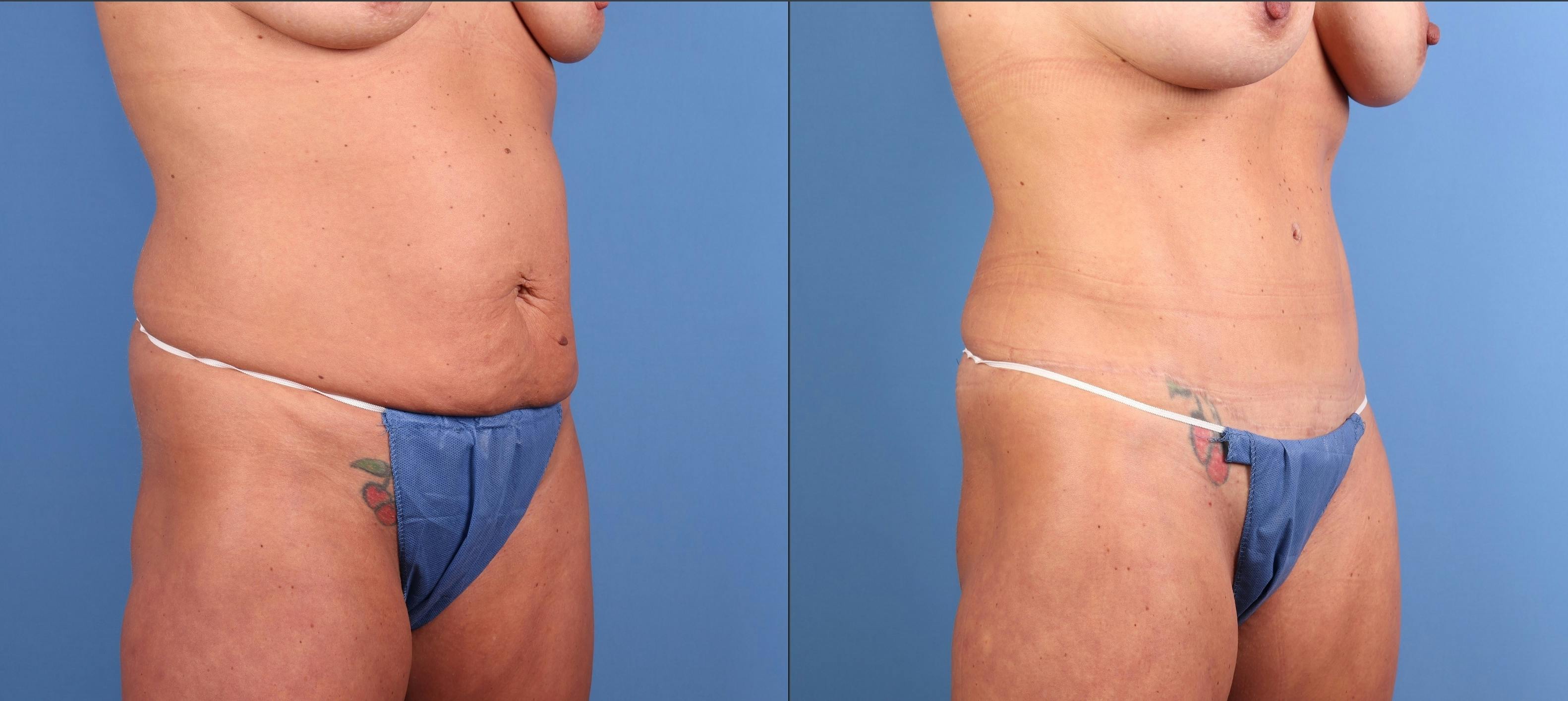 Mommy Makeover Before & After Gallery - Patient 127893 - Image 2