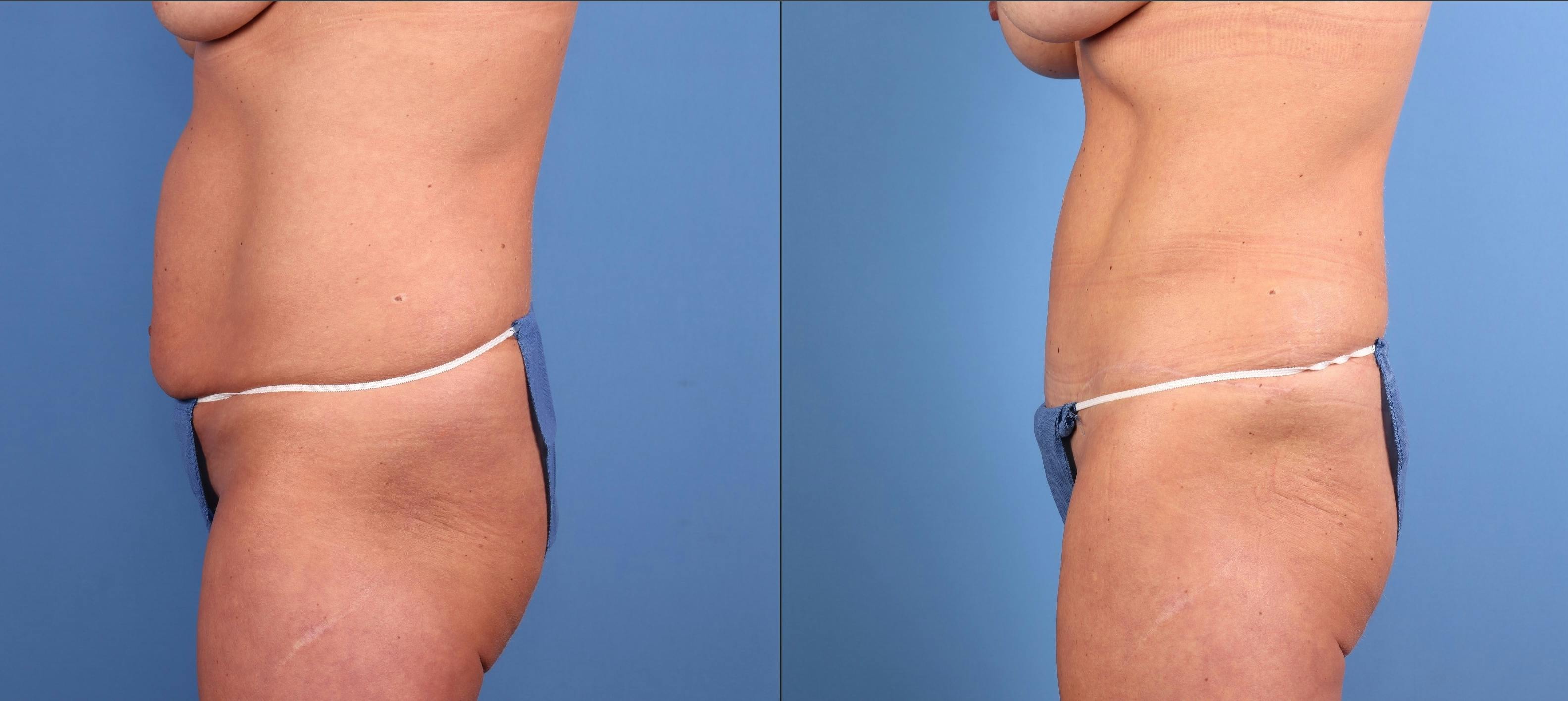 Mommy Makeover Before & After Gallery - Patient 127893 - Image 5