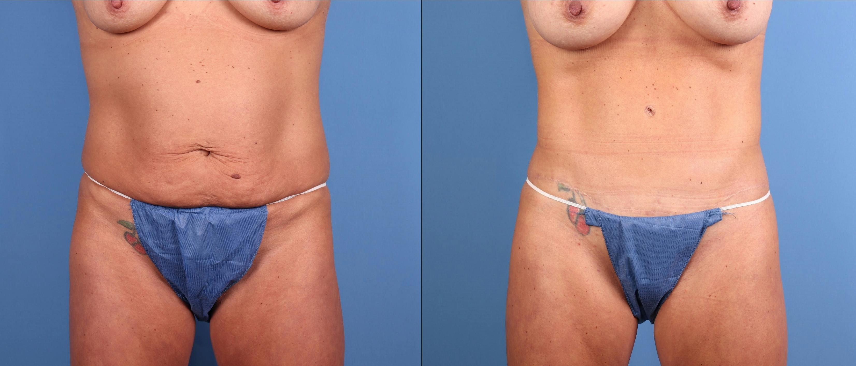 Tummy Tuck Before & After Gallery - Patient 192250 - Image 1