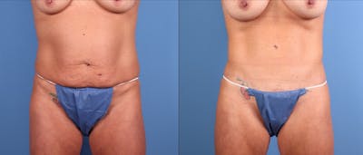 Tummy Tuck Before & After Gallery - Patient 192250 - Image 1