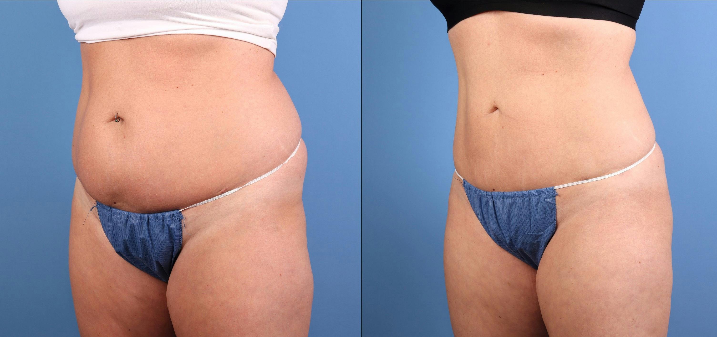 Fat Grafting Before & After Gallery - Patient 174205 - Image 2