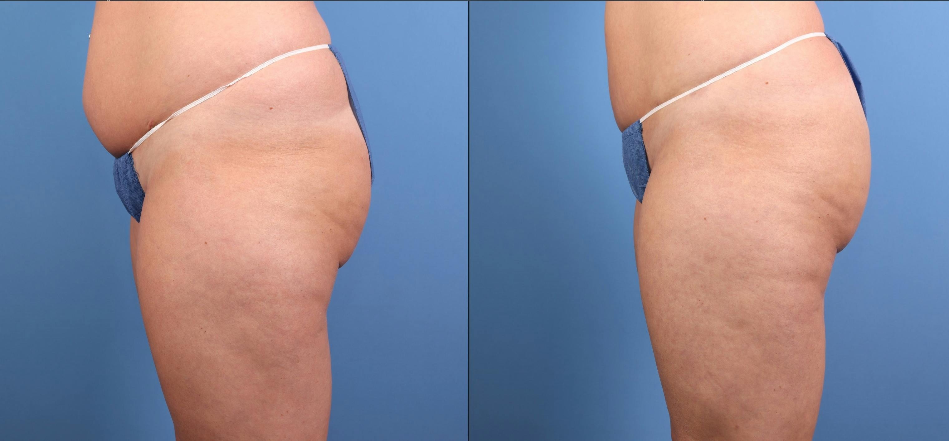 Fat Grafting Before & After Gallery - Patient 174205 - Image 12
