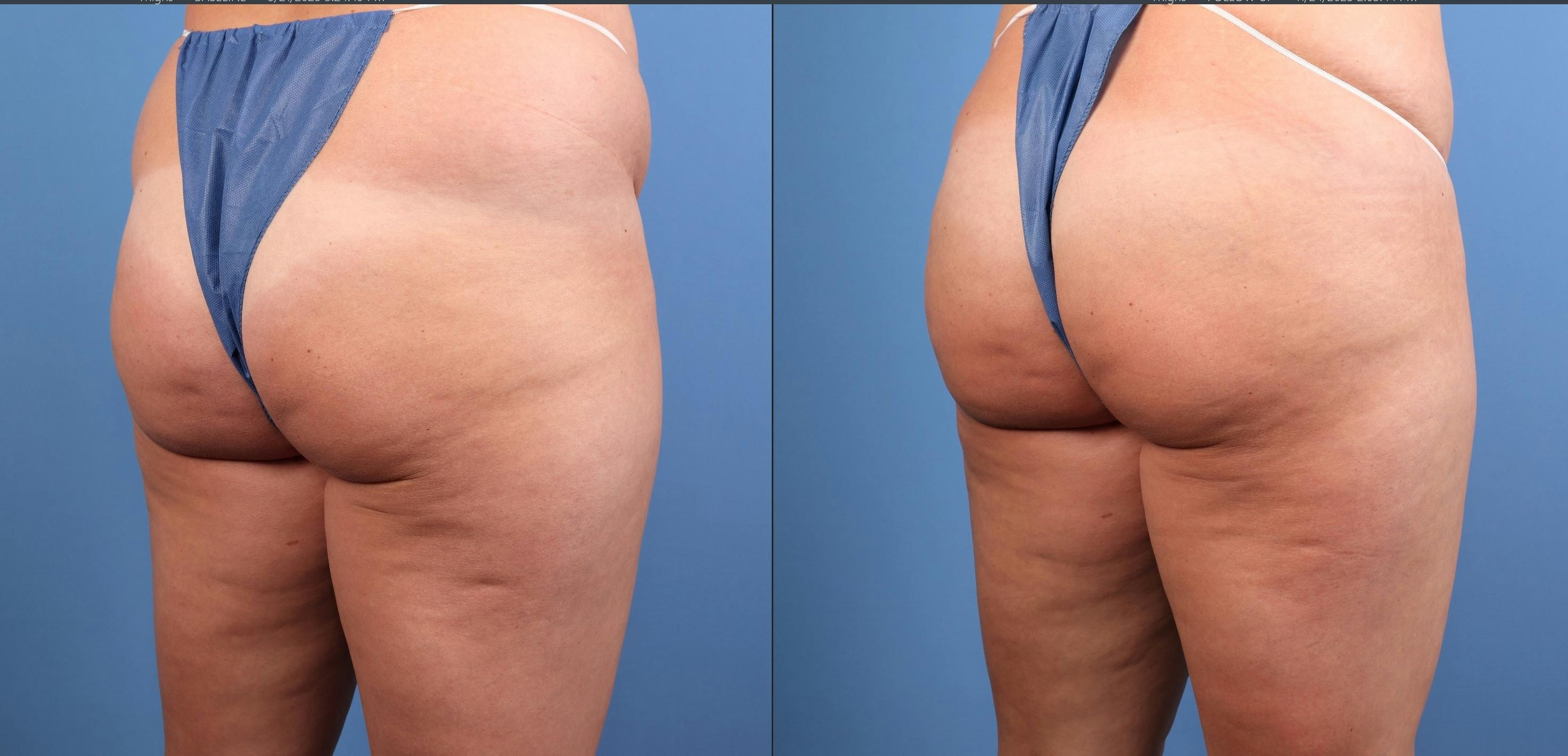 Fat Grafting Before & After Gallery - Patient 174205 - Image 11