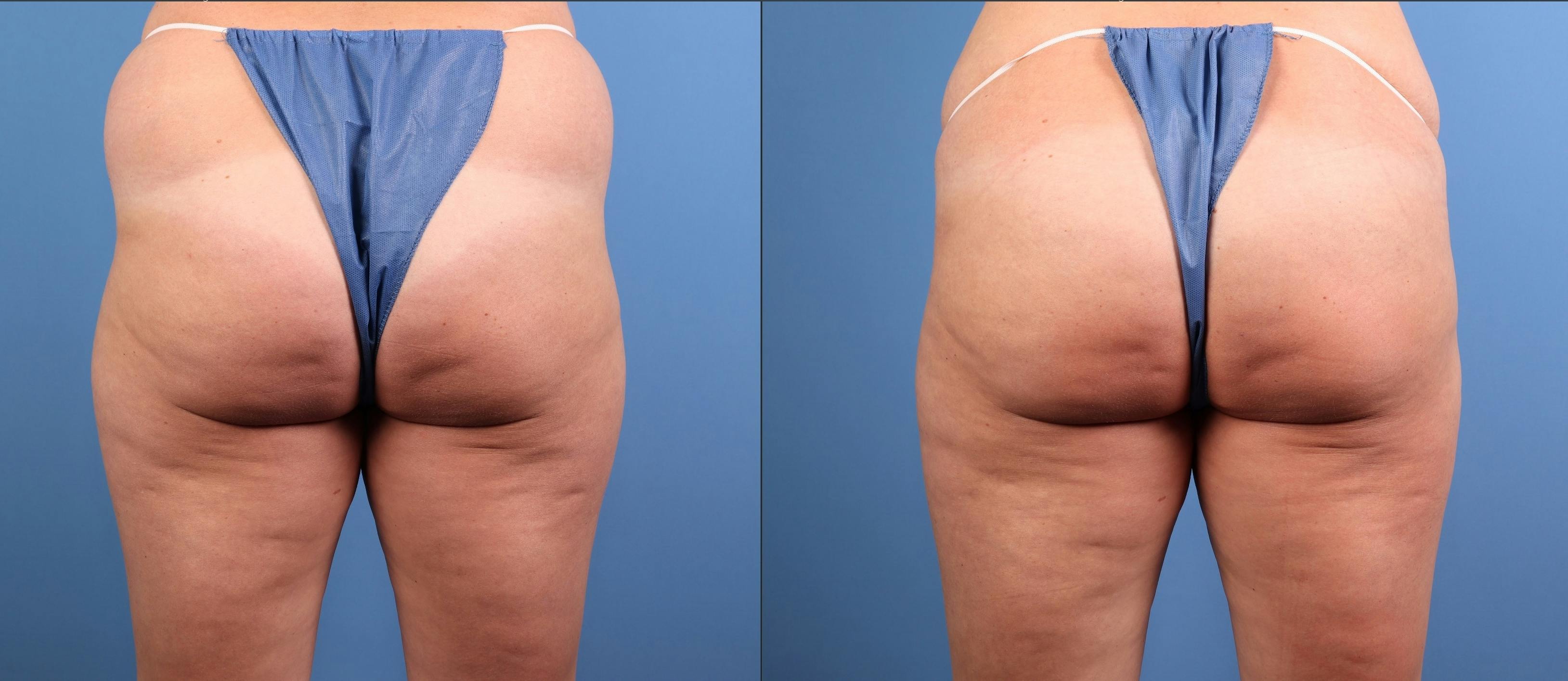 Fat Grafting Before & After Gallery - Patient 174205 - Image 10