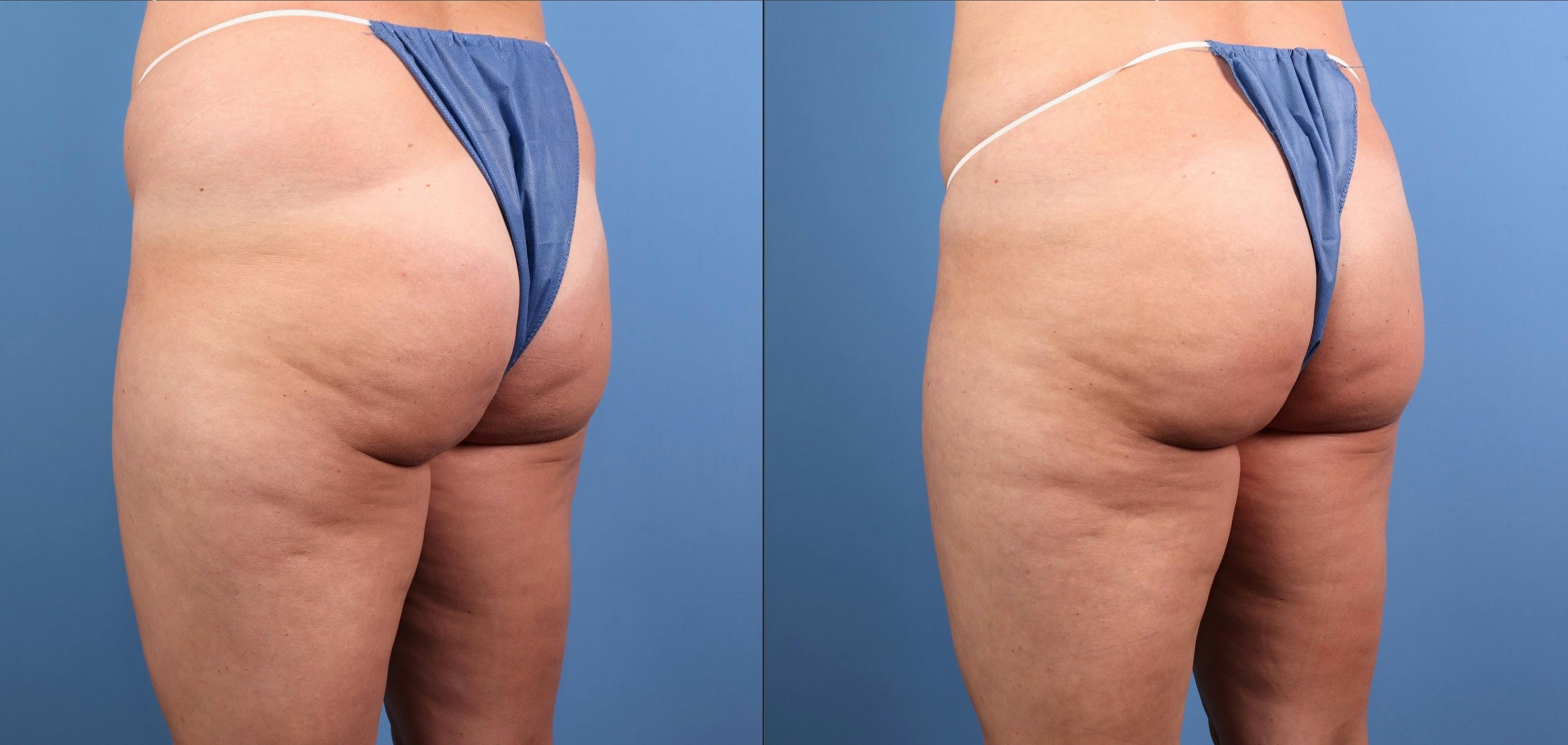 Fat Grafting Before & After Gallery - Patient 174205 - Image 6