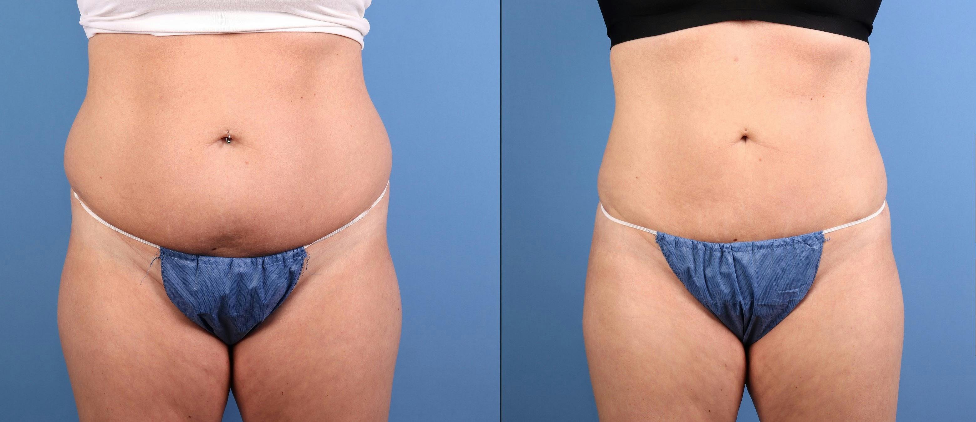 Fat Grafting Before & After Gallery - Patient 174205 - Image 1