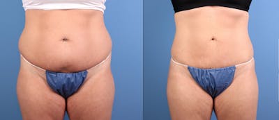 Abdomen Before & After Gallery - Patient 263111 - Image 1