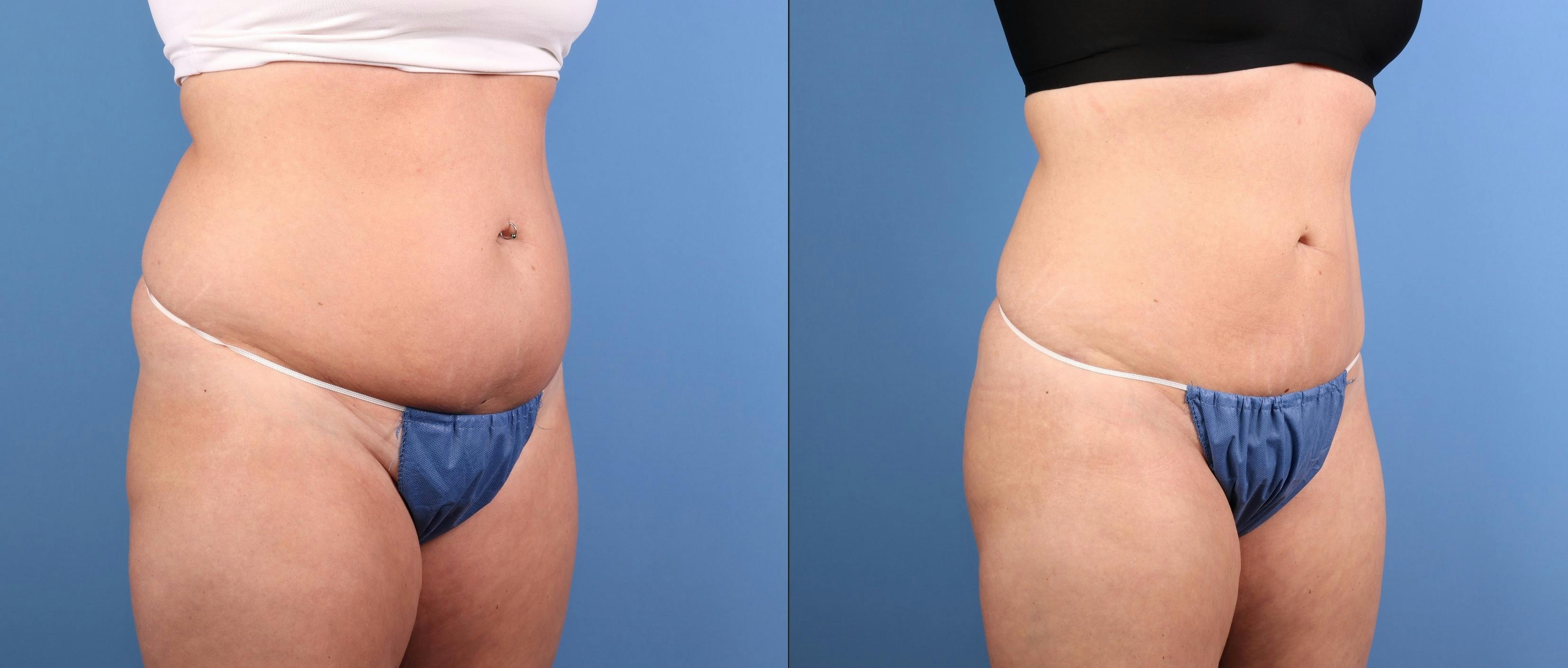 Fat Grafting Before & After Gallery - Patient 174205 - Image 4