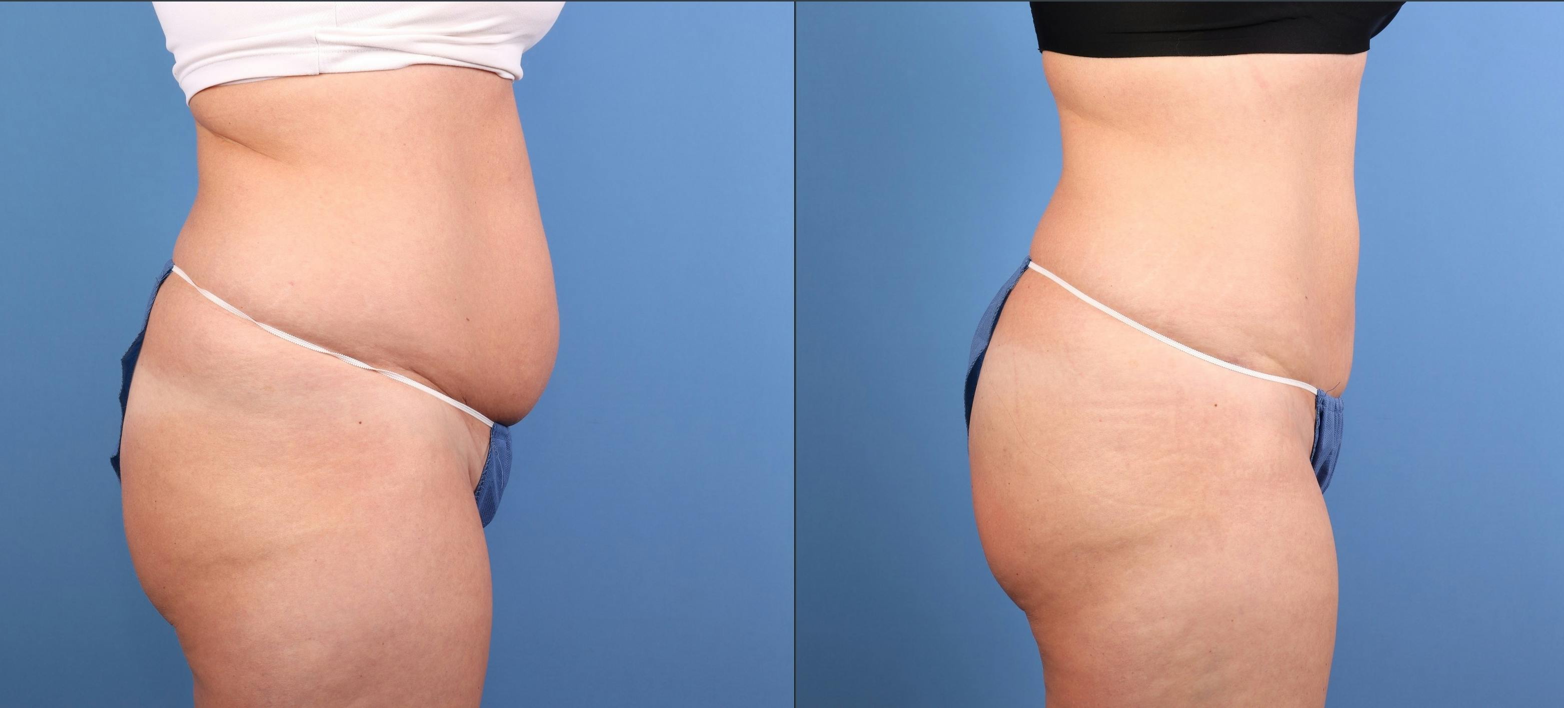 Fat Grafting Before & After Gallery - Patient 174205 - Image 5