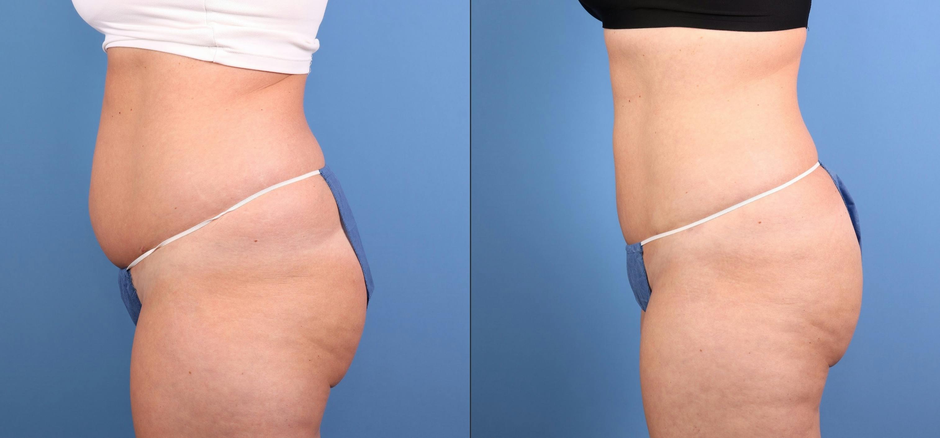 Fat Grafting Before & After Gallery - Patient 174205 - Image 3