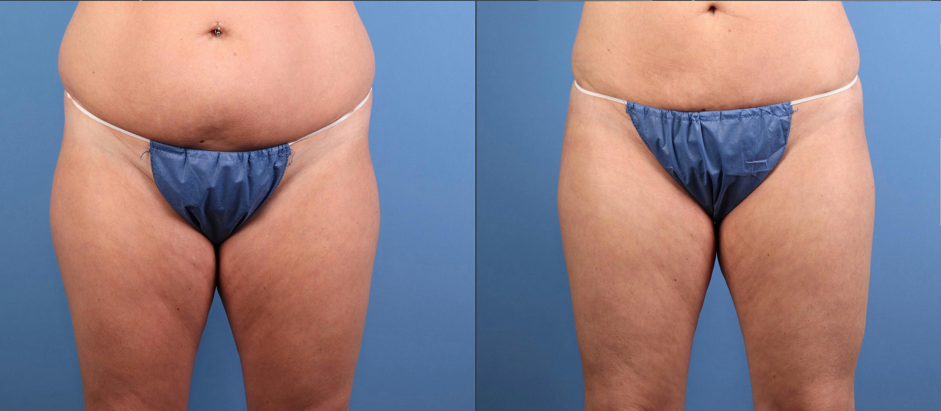 Fat Grafting Before & After Gallery - Patient 174205 - Image 7