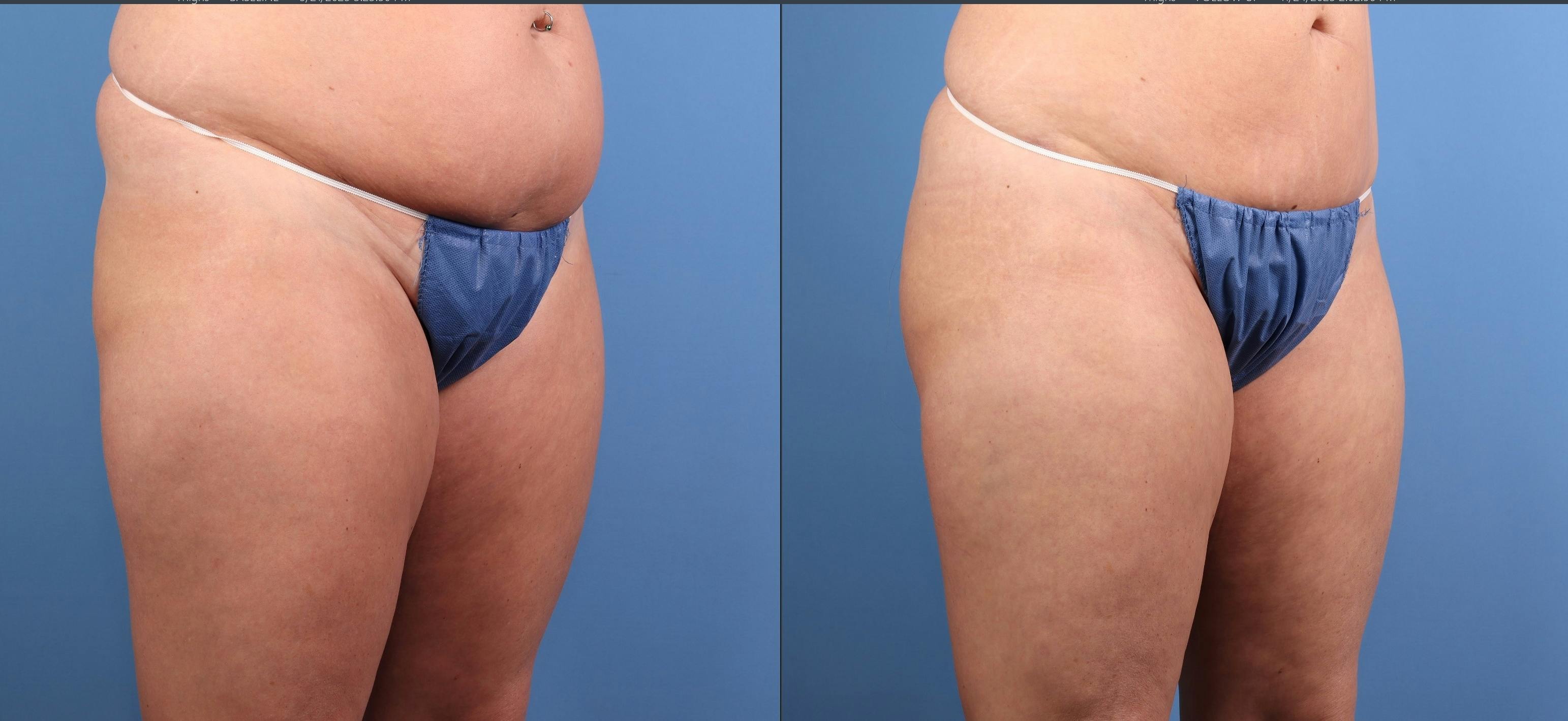 Fat Grafting Before & After Gallery - Patient 174205 - Image 8