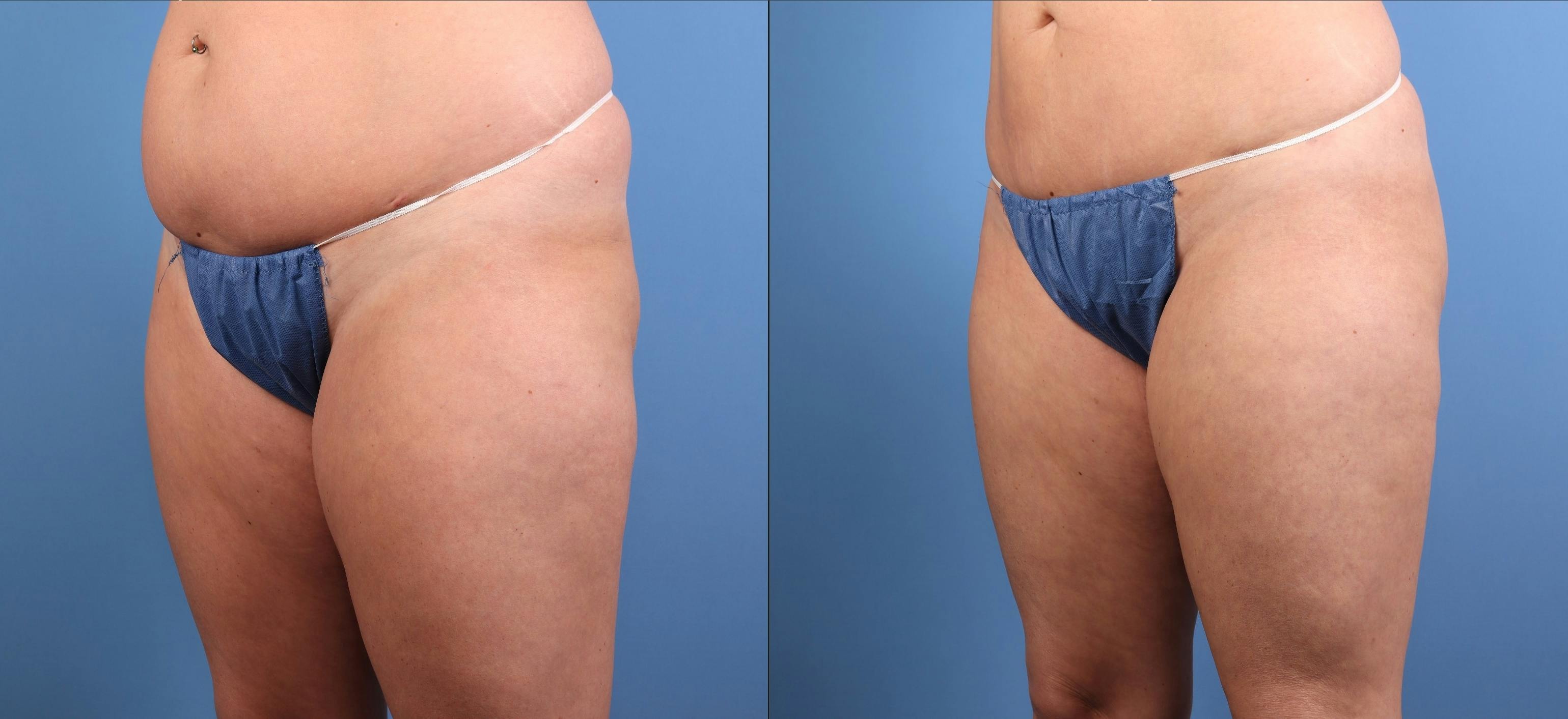 Fat Grafting Before & After Gallery - Patient 174205 - Image 9