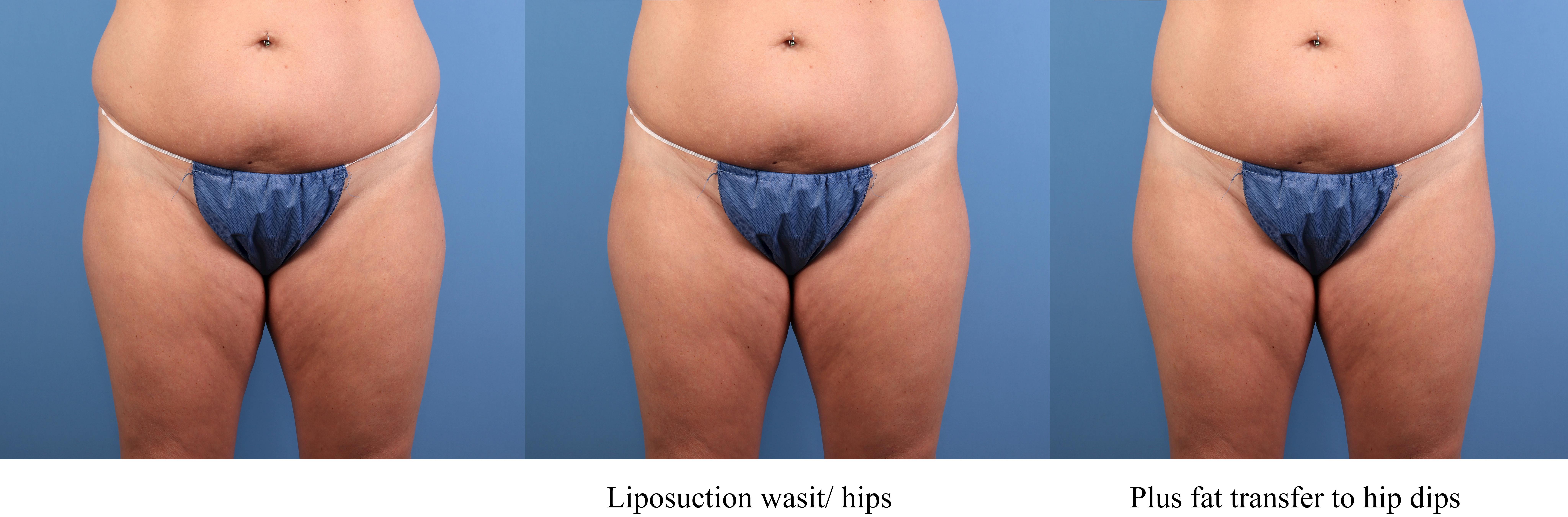 Fat Grafting Before & After Gallery - Patient 174205 - Image 13