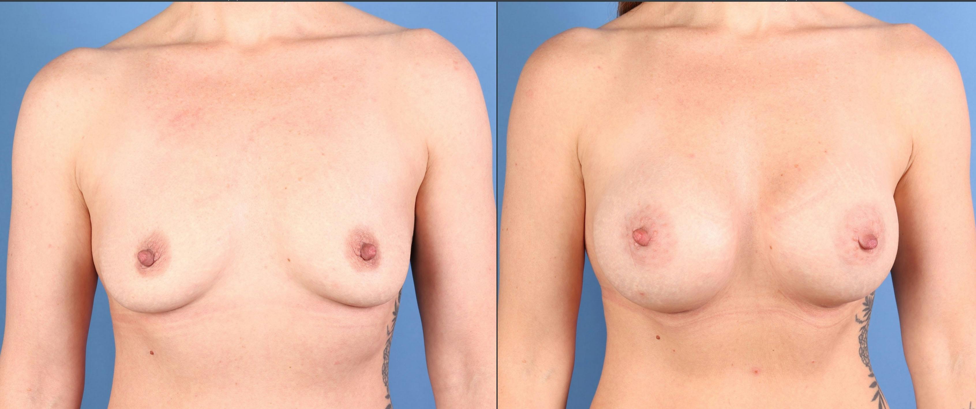 Breast Augmentation Before & After Gallery - Patient 363700 - Image 1