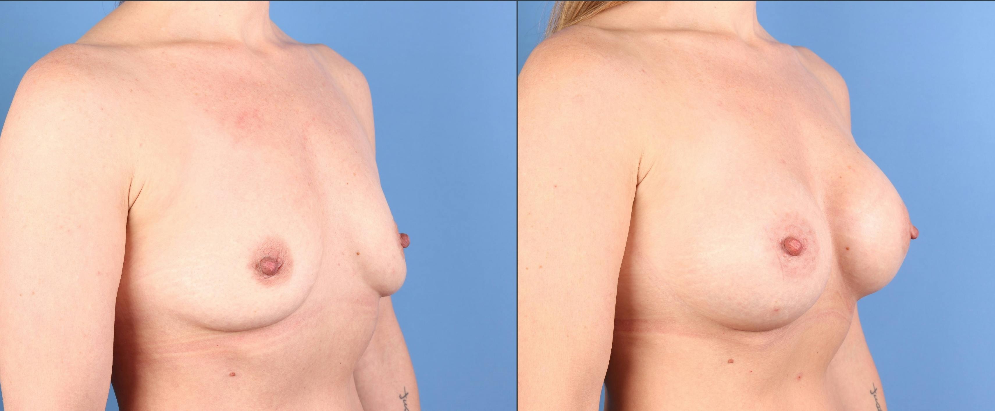 Breast Augmentation Before & After Gallery - Patient 363700 - Image 4
