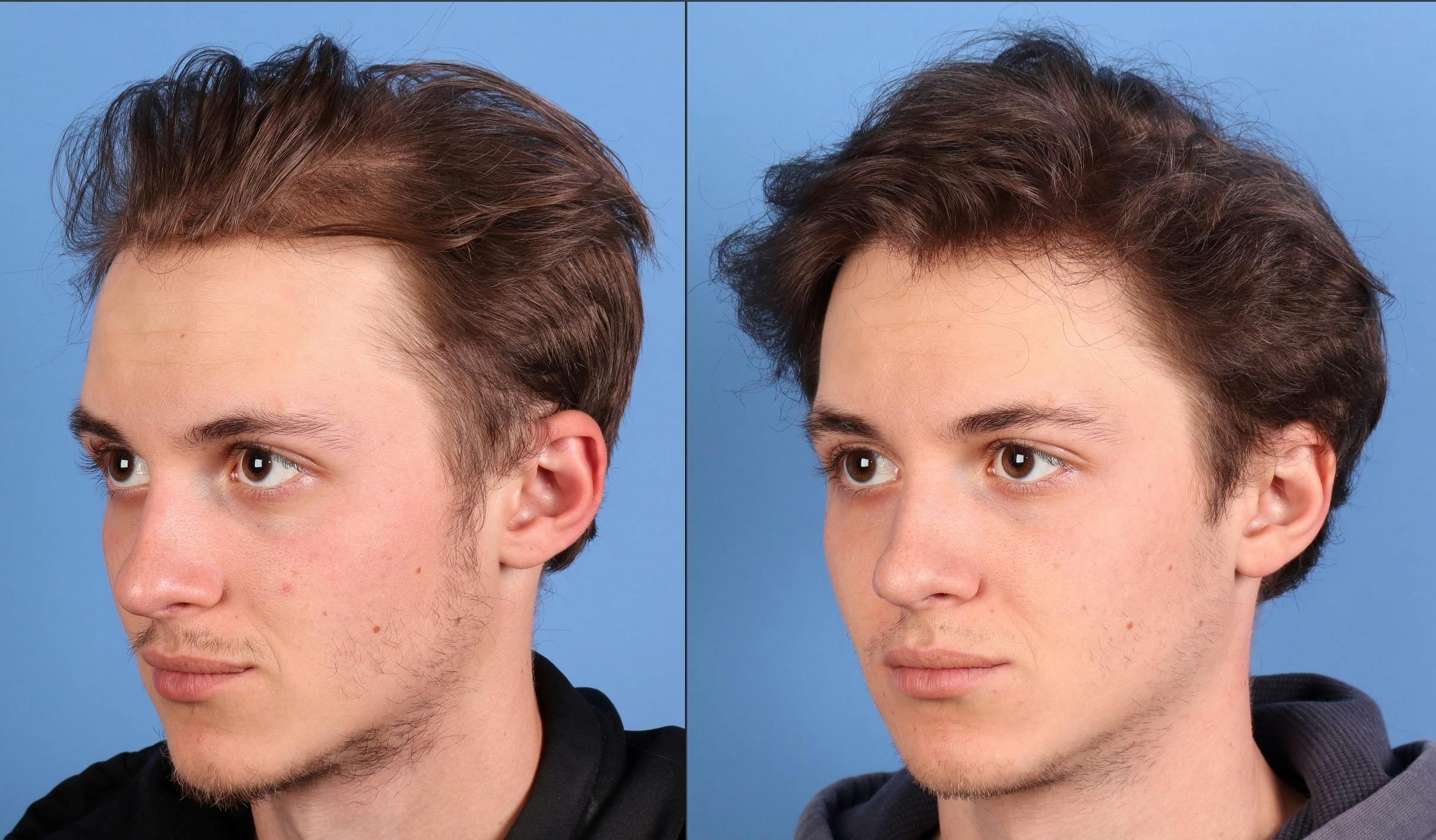 NeoGraft Hair Restoration Before & After Gallery - Patient 294323 - Image 4