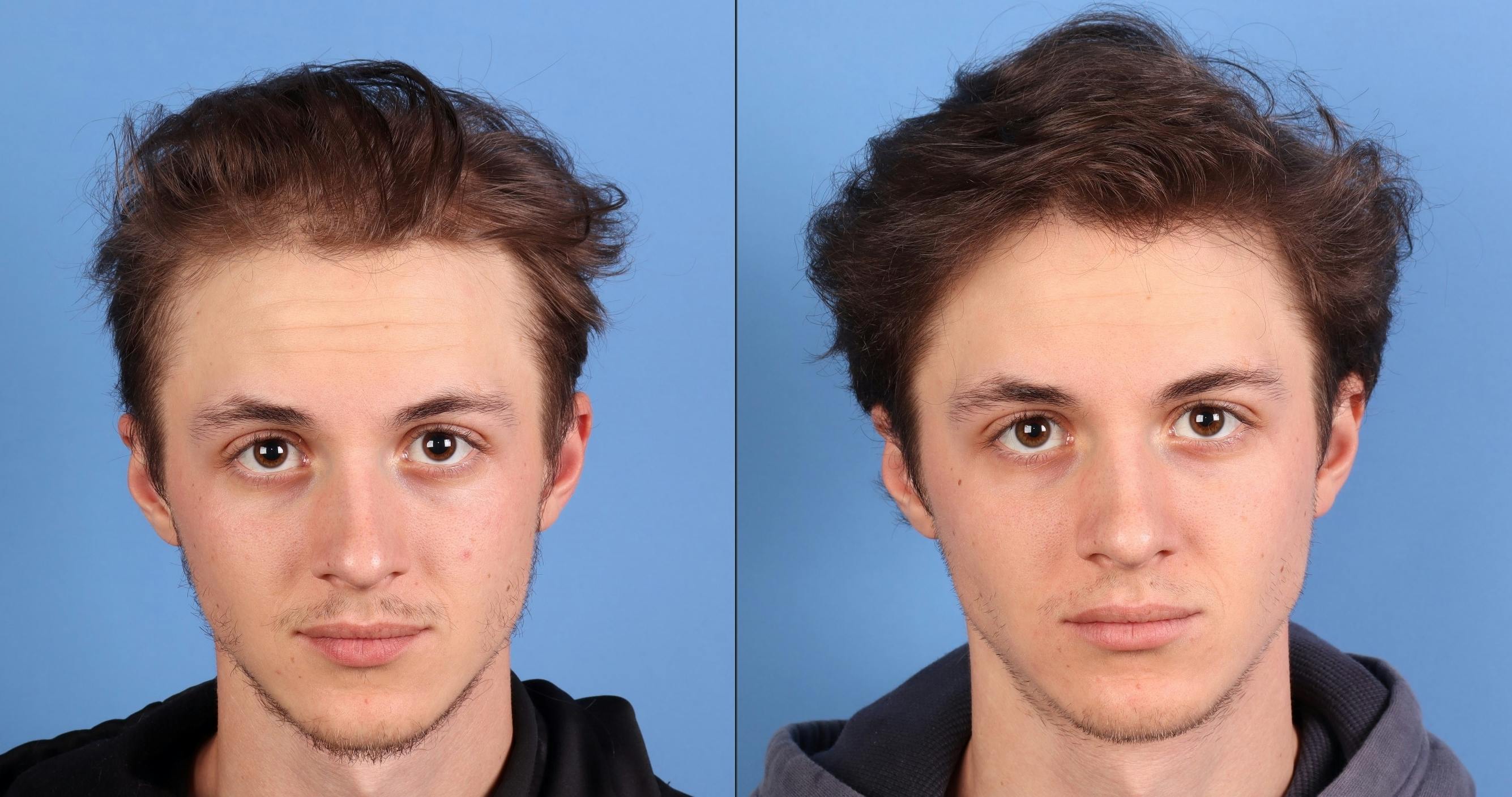 NeoGraft Hair Restoration Before & After Gallery - Patient 294323 - Image 1