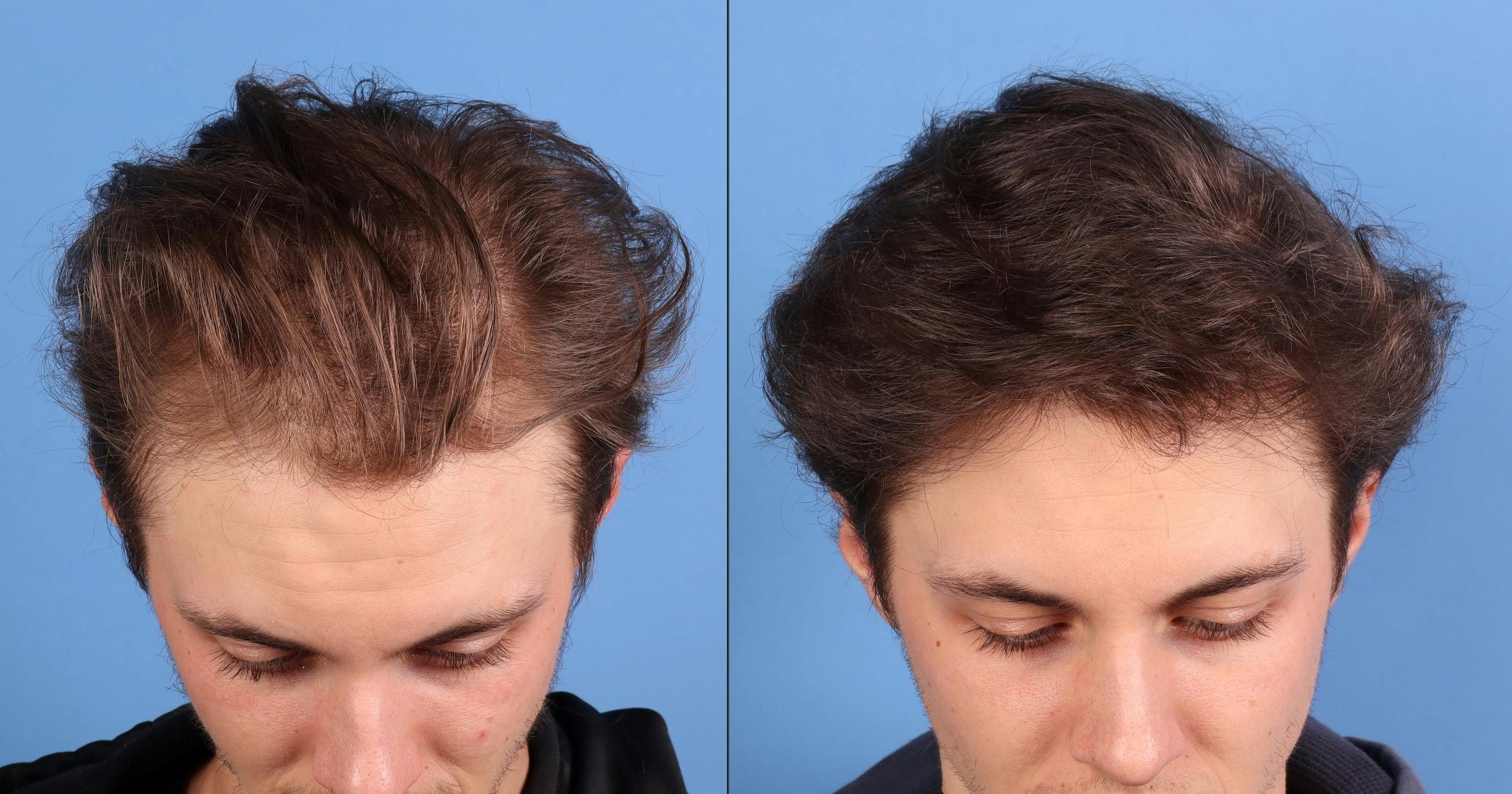 NeoGraft Hair Restoration Before & After Gallery - Patient 294323 - Image 2