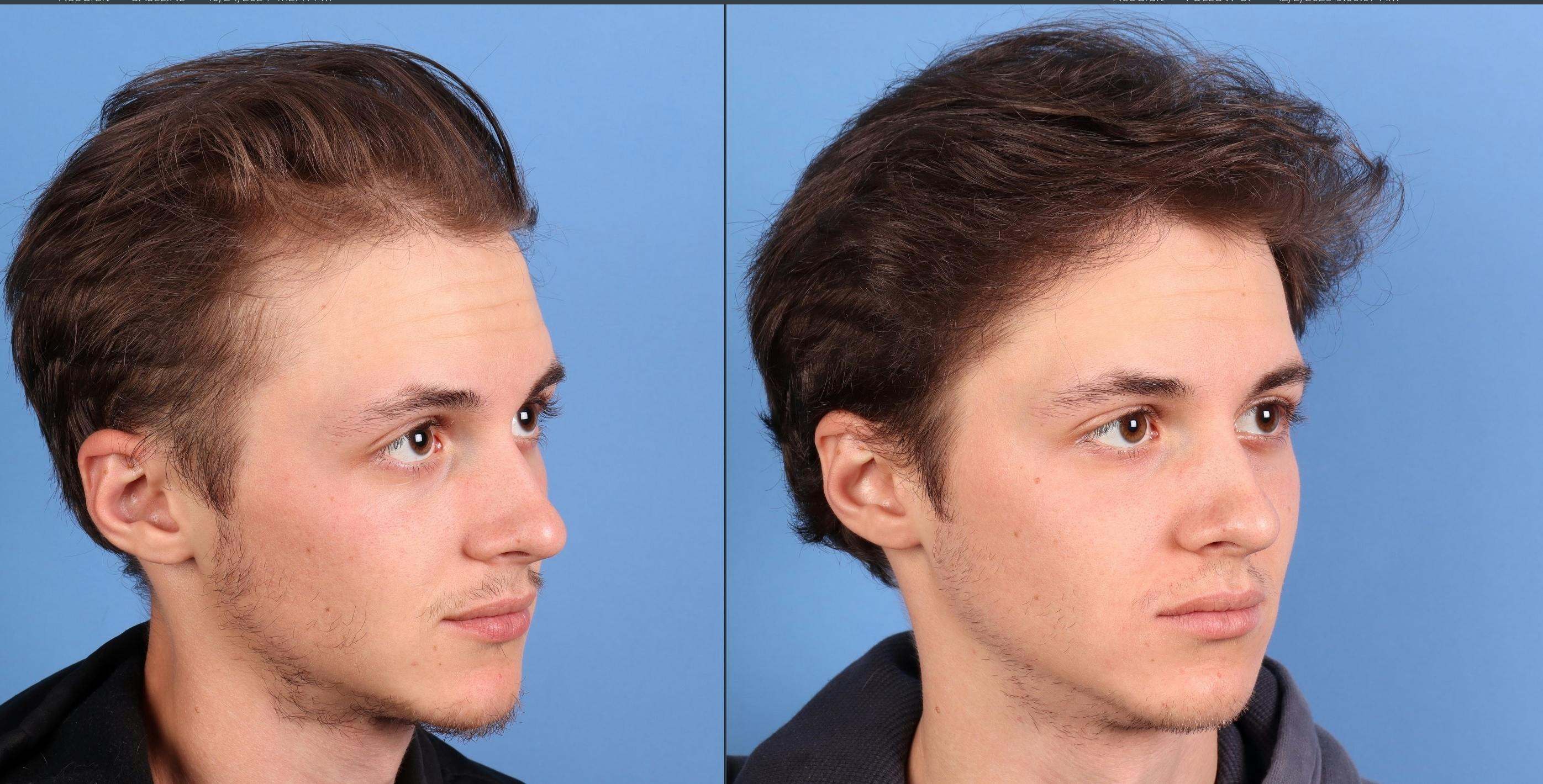 NeoGraft Hair Restoration Before & After Gallery - Patient 294323 - Image 3