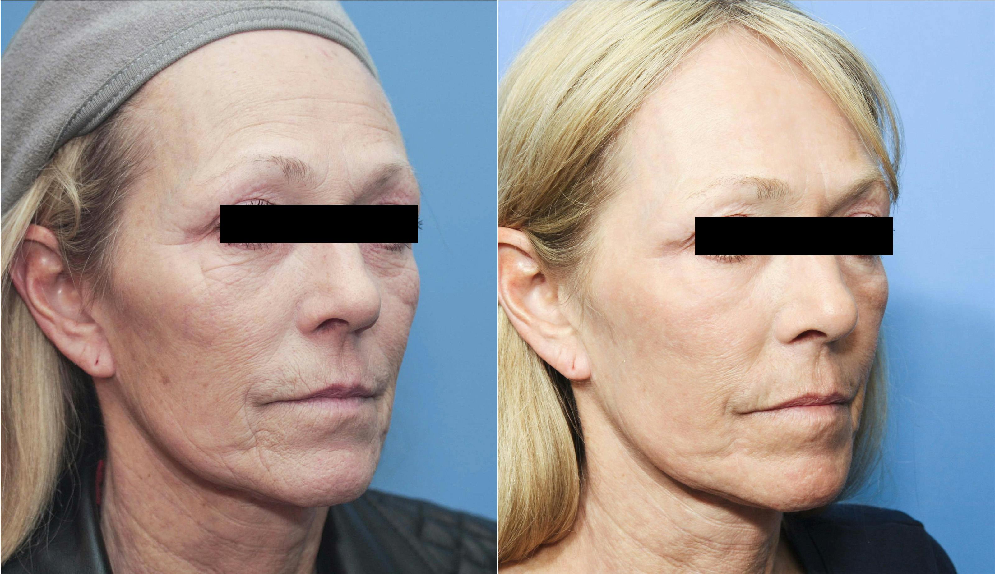 Contour TRL Laser Before & After Gallery - Patient 58214362 - Image 2