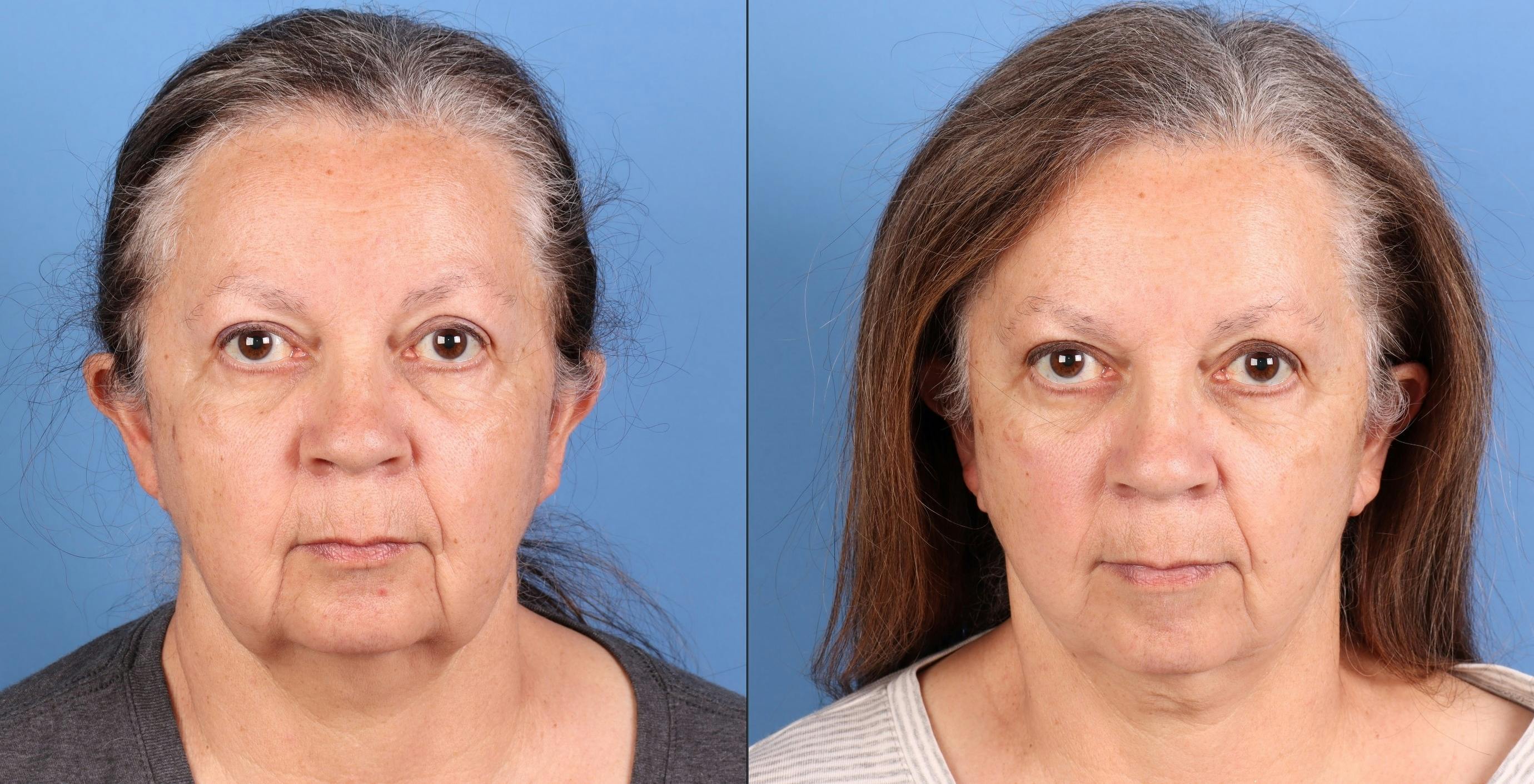 Face Lift Before & After Gallery - Patient 110429 - Image 1