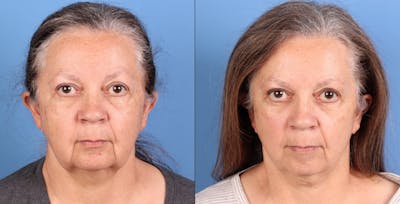 Face Lift Before & After Gallery - Patient 110429 - Image 1