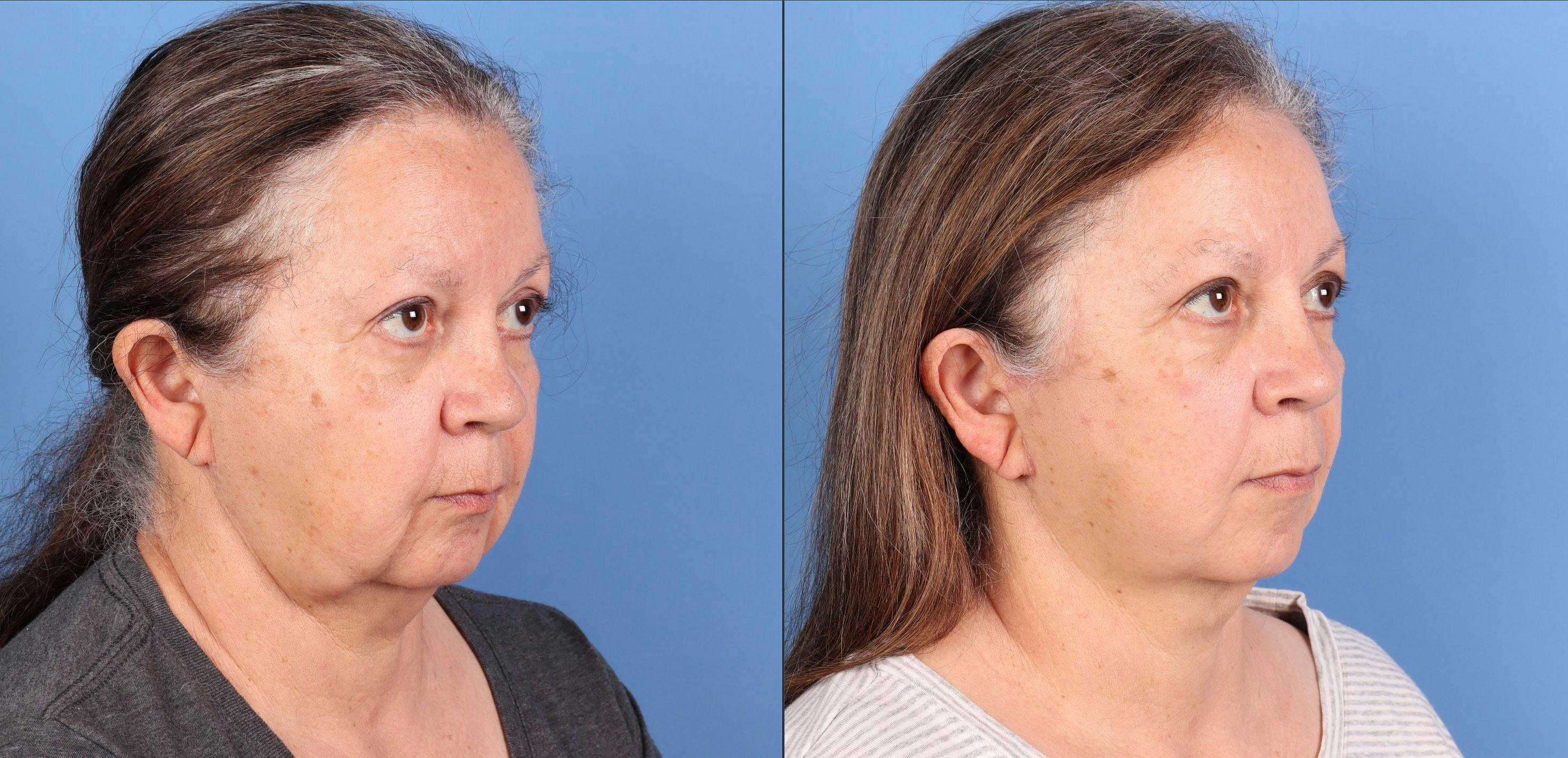 Face Lift Before & After Gallery - Patient 110429 - Image 2