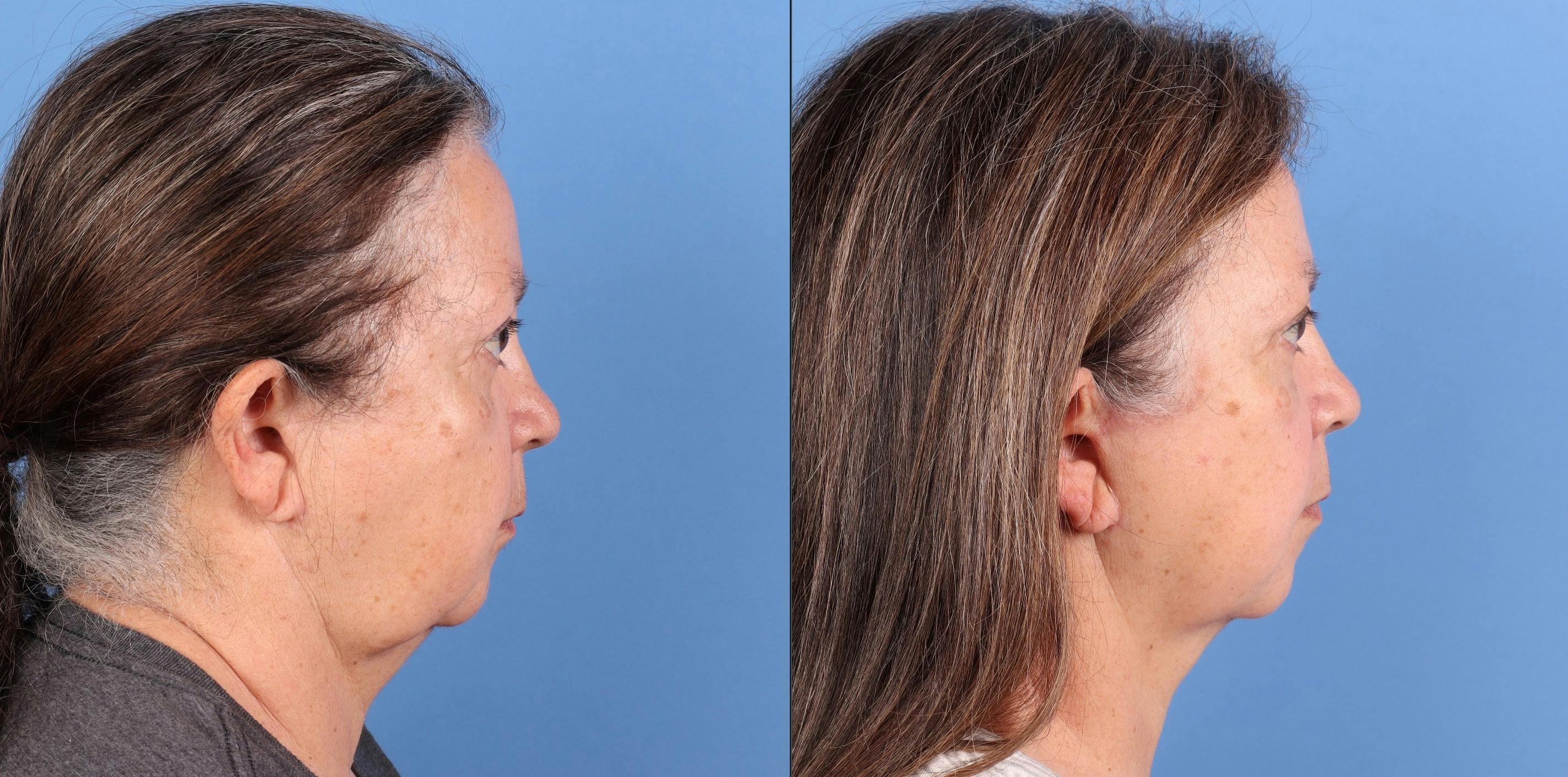 Face Lift Before & After Gallery - Patient 110429 - Image 3