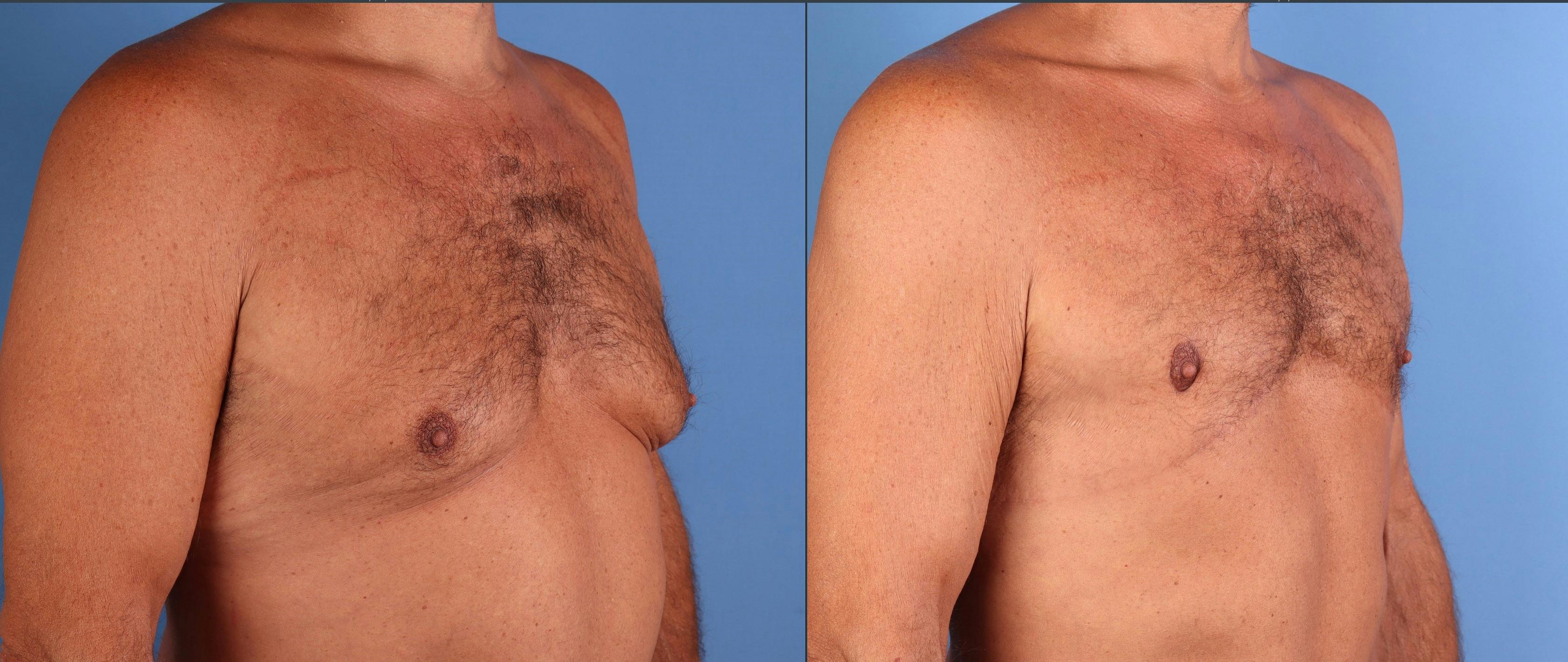 Male Breast Reduction Before & After Gallery - Patient 216233 - Image 2
