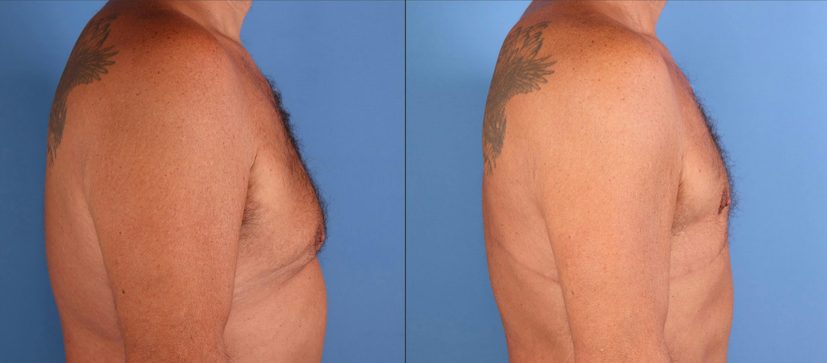 Male Breast Reduction Before & After Gallery - Patient 216233 - Image 3