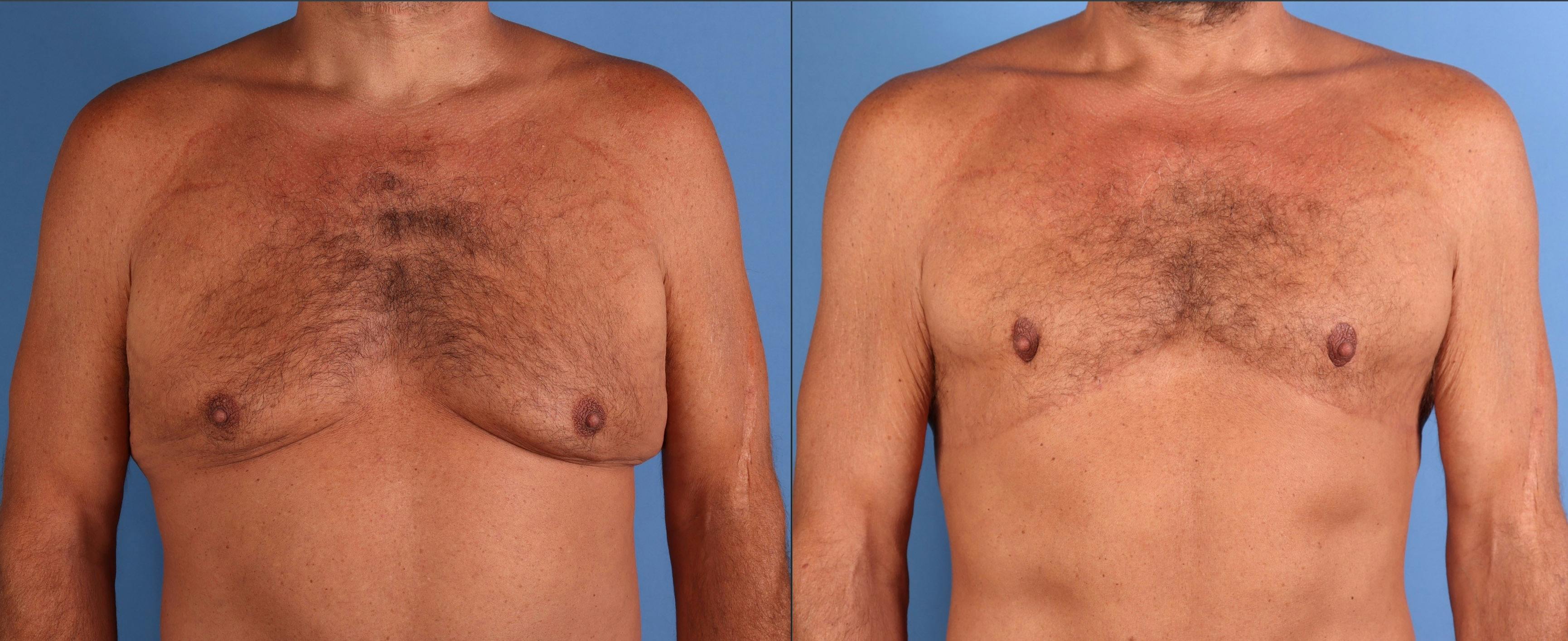 Male Breast Reduction Before & After Gallery - Patient 216233 - Image 1